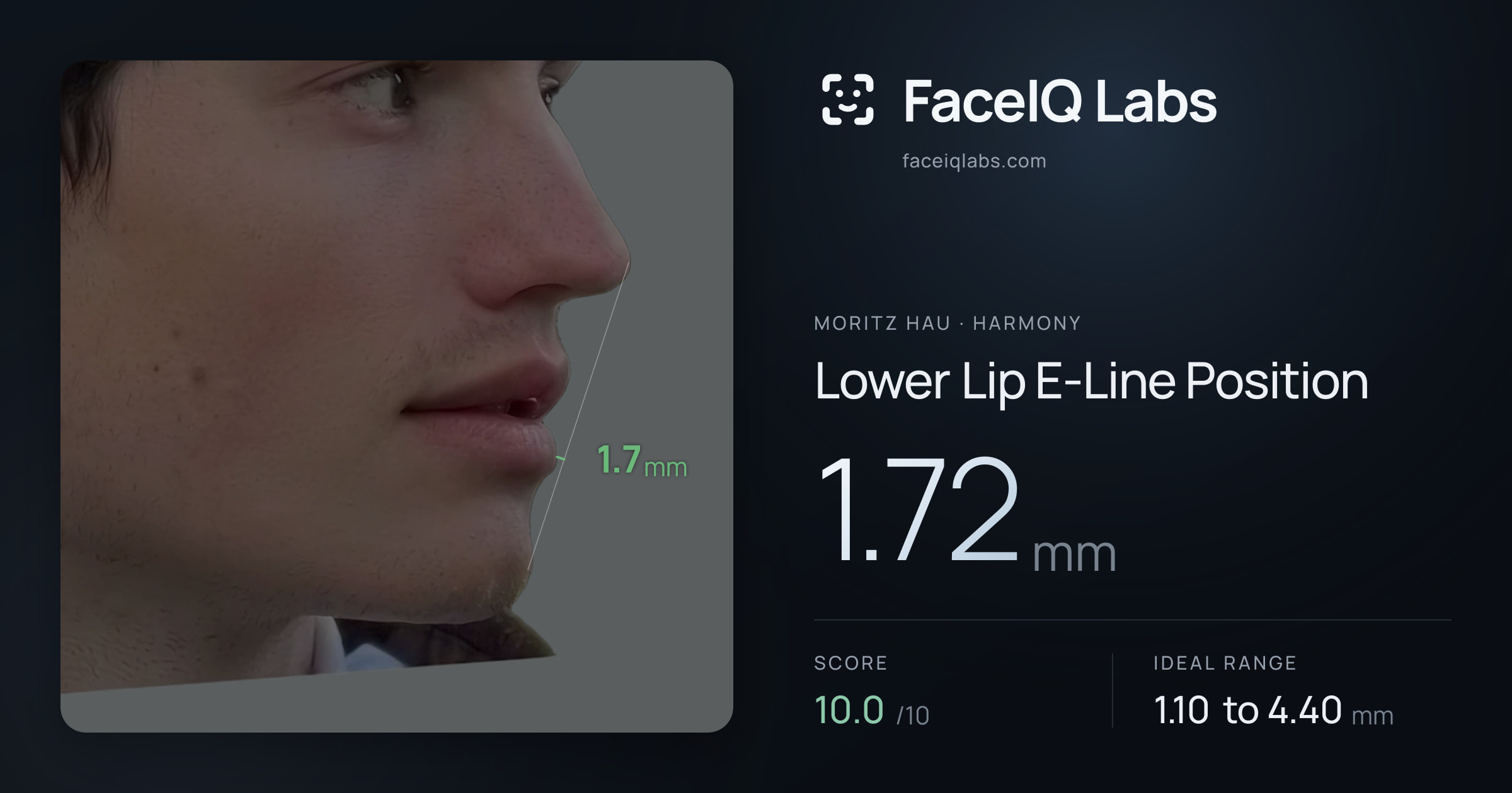 Moritz Hau Lower Lip E-Line Position: 1.72mm, drawn on the photo