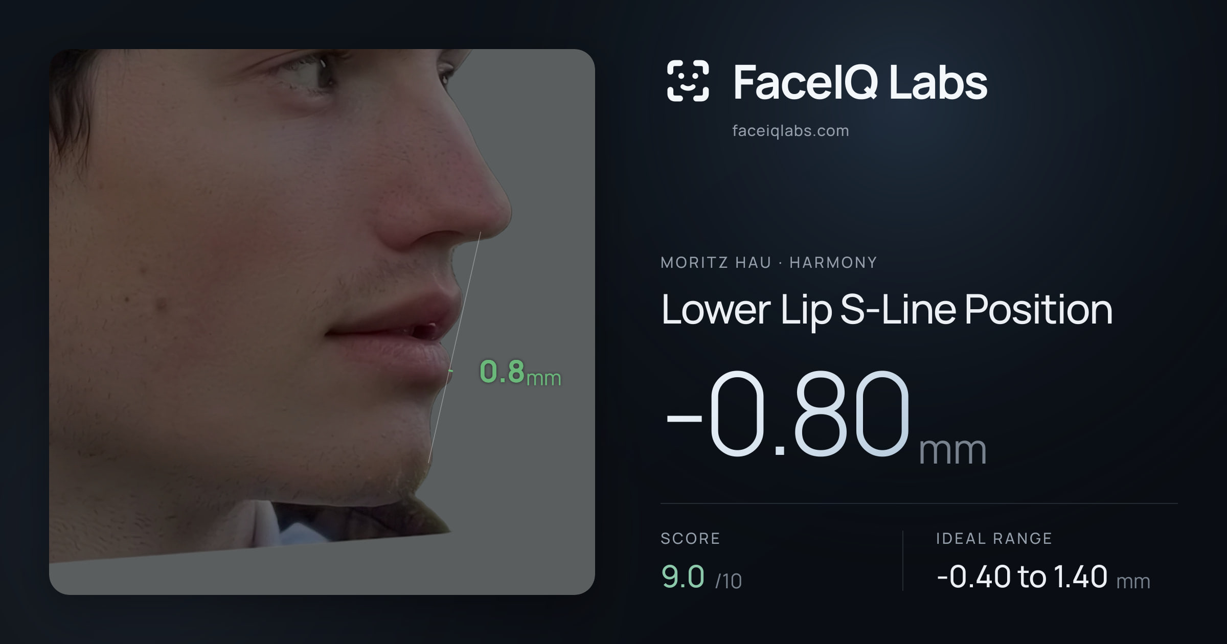 Moritz Hau Lower Lip S-Line Position: -0.80mm, drawn on the photo