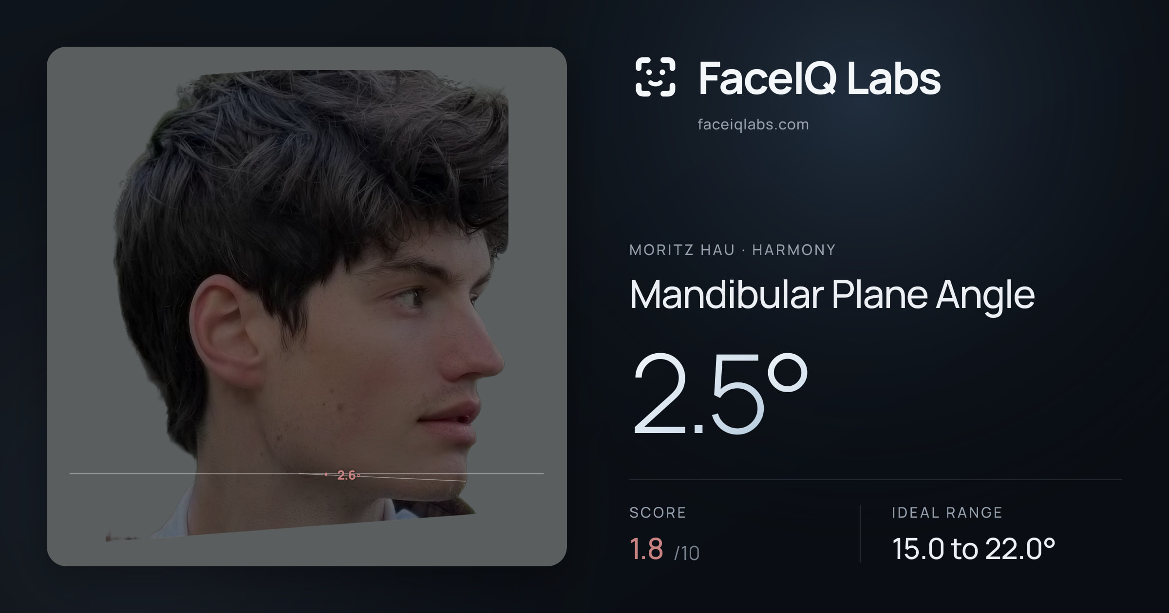 Moritz Hau Mandibular Plane Angle: 2.5°, drawn on the photo