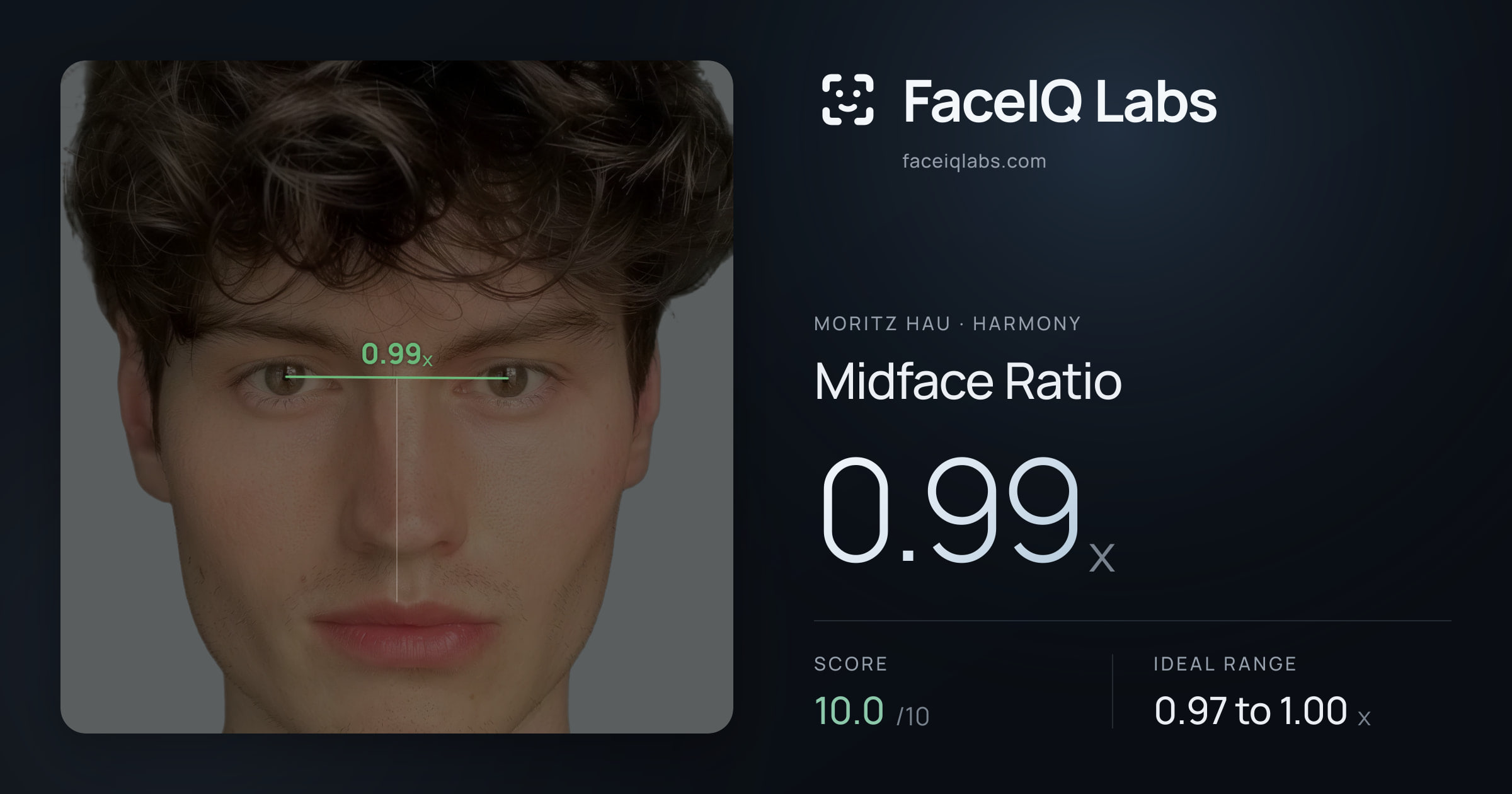 Moritz Hau Midface Ratio: 0.99x, drawn on the photo
