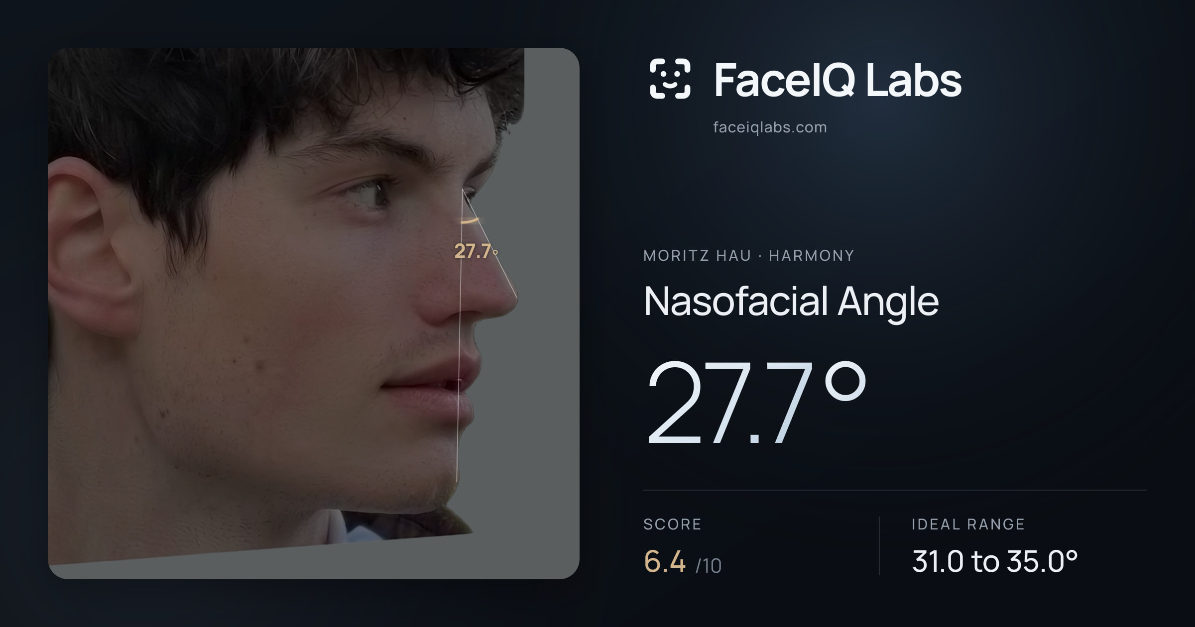Moritz Hau Nasofacial Angle: 27.7°, drawn on the photo