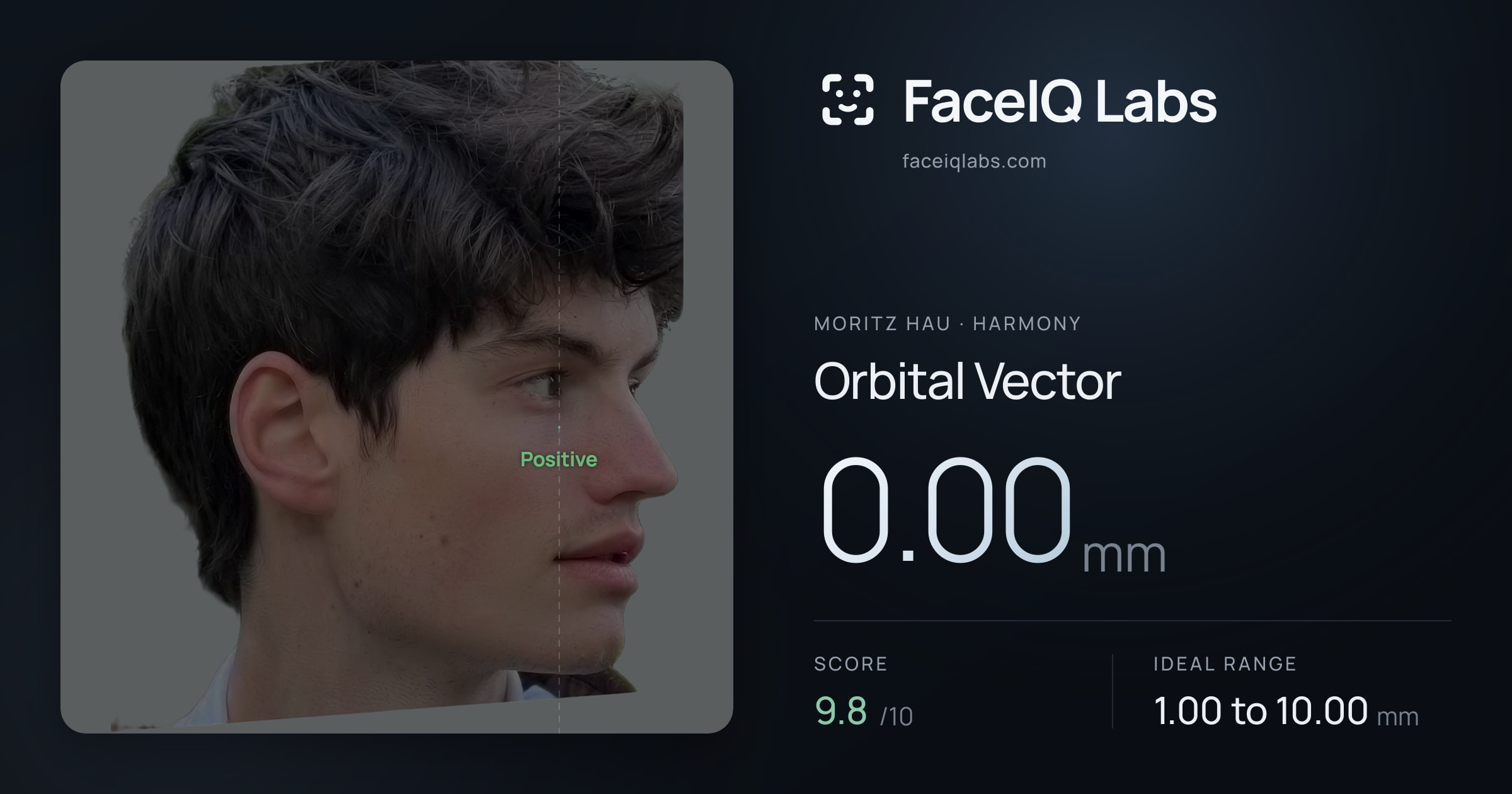Moritz Hau Orbital Vector: 0.00mm, drawn on the photo