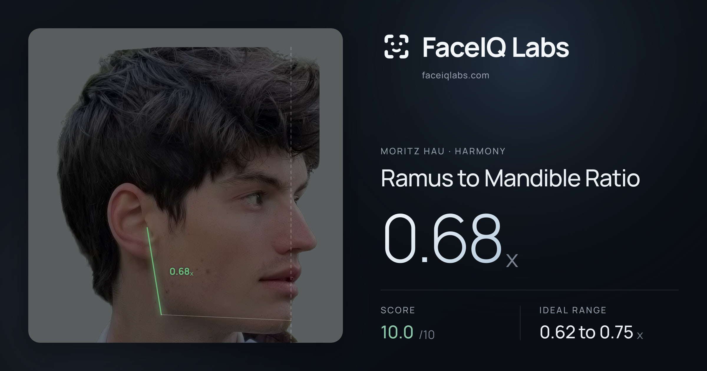 Moritz Hau Ramus to Mandible Ratio: 0.68x, drawn on the photo