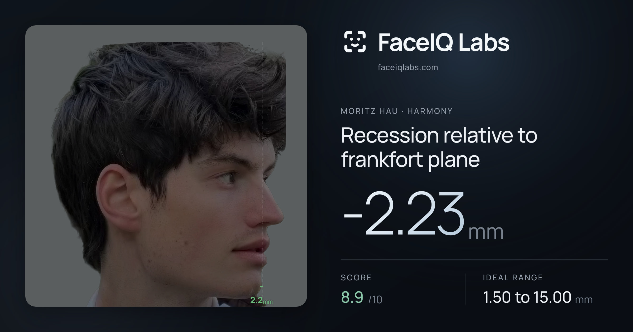Moritz Hau Recession relative to frankfort plane: -2.23mm, drawn on the photo