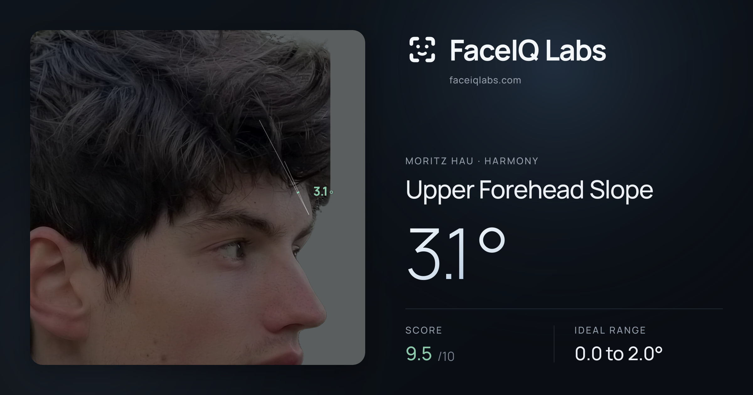 Moritz Hau Upper Forehead Slope: 3.1°, drawn on the photo