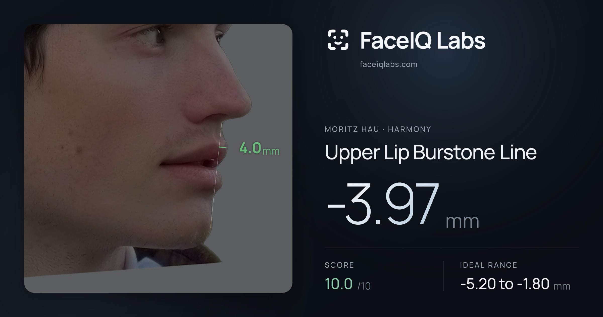 Moritz Hau Upper Lip Burstone Line: -3.97mm, drawn on the photo