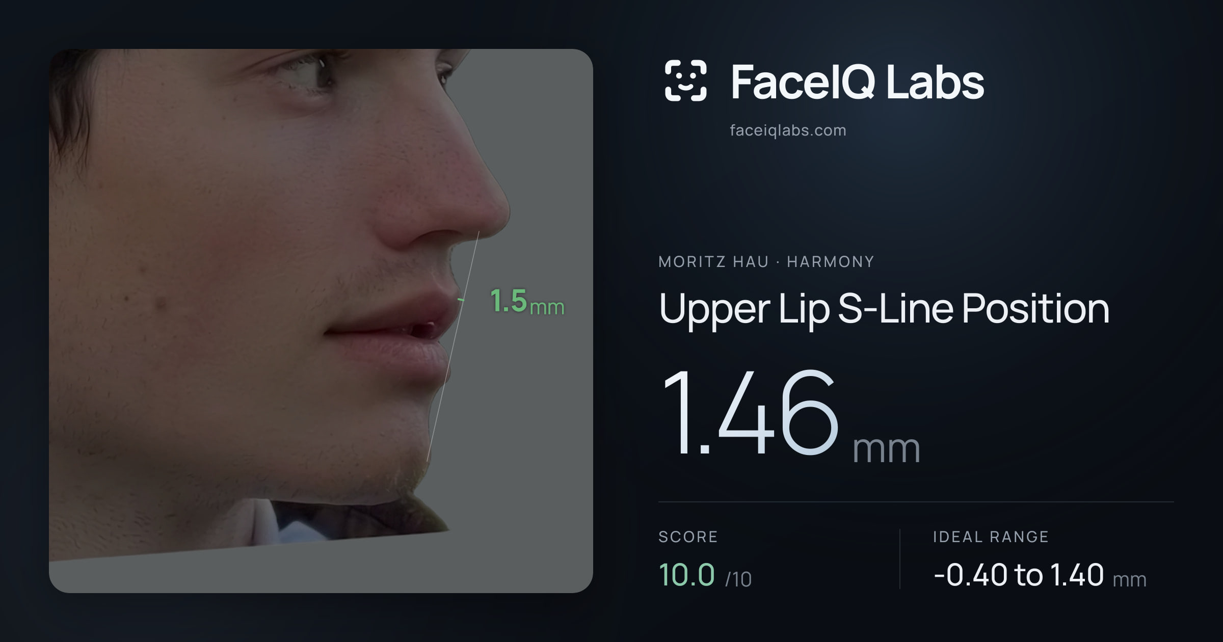 Moritz Hau Upper Lip S-Line Position: 1.46mm, drawn on the photo