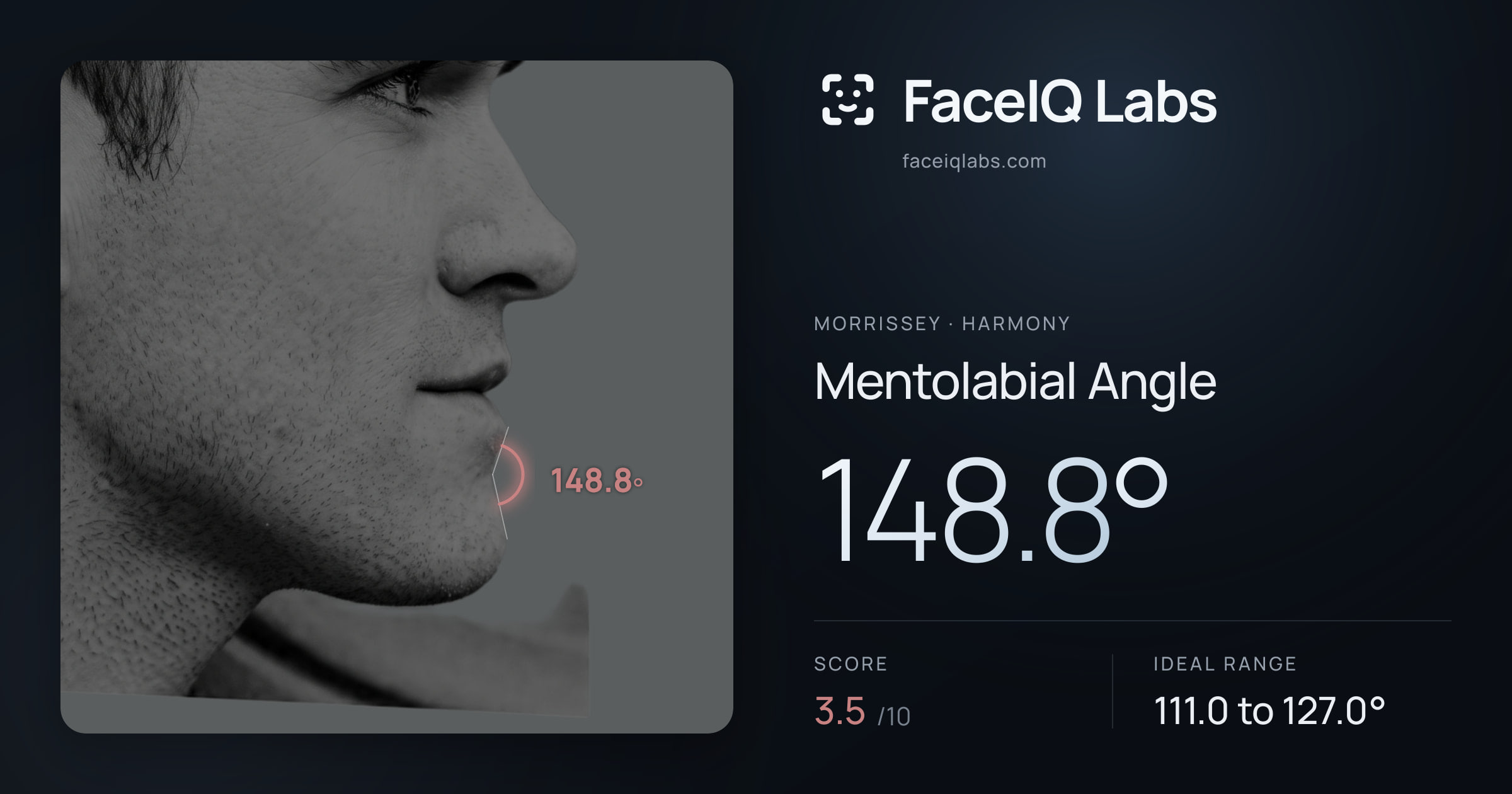 Morrissey Mentolabial Angle: 148.8°, drawn on the photo