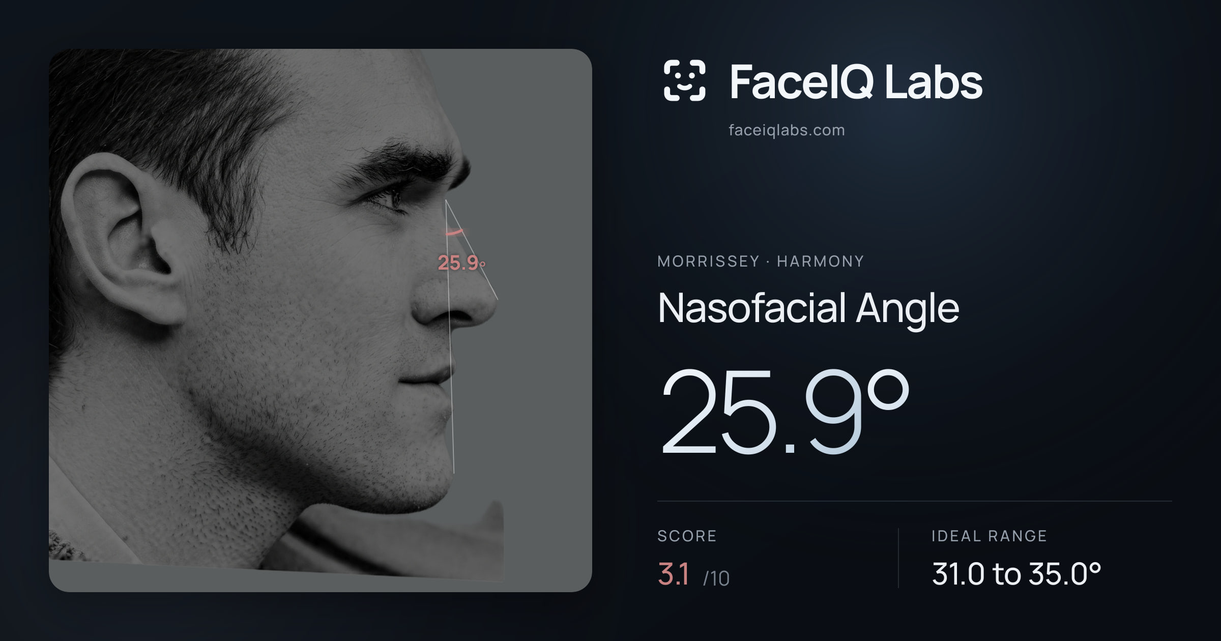 Morrissey Nasofacial Angle: 25.9°, drawn on the photo