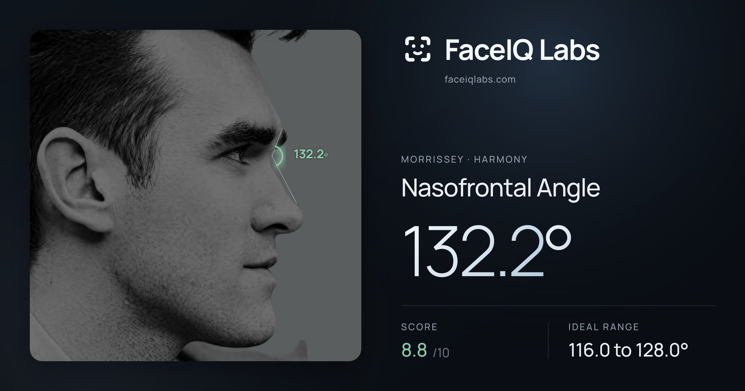 Morrissey Nasofrontal Angle: 132.2°, drawn on the photo