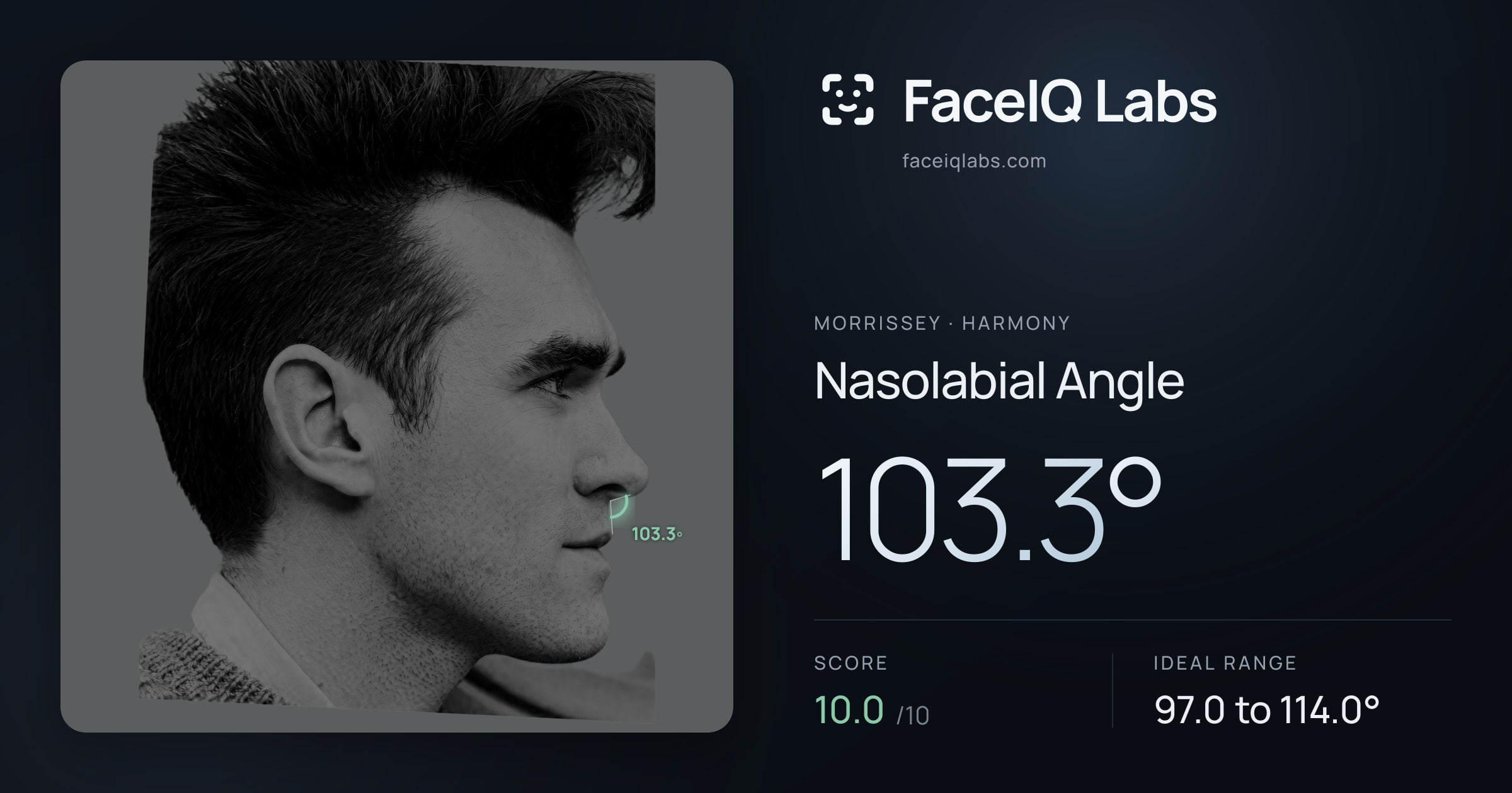 Morrissey Nasolabial Angle: 103.3°, drawn on the photo