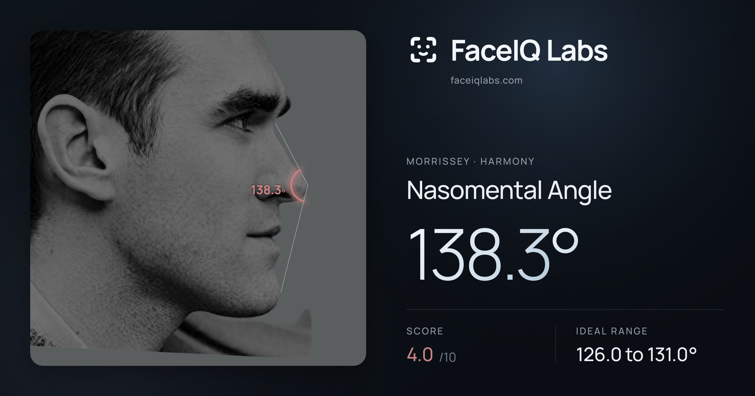 Morrissey Nasomental Angle: 138.3°, drawn on the photo