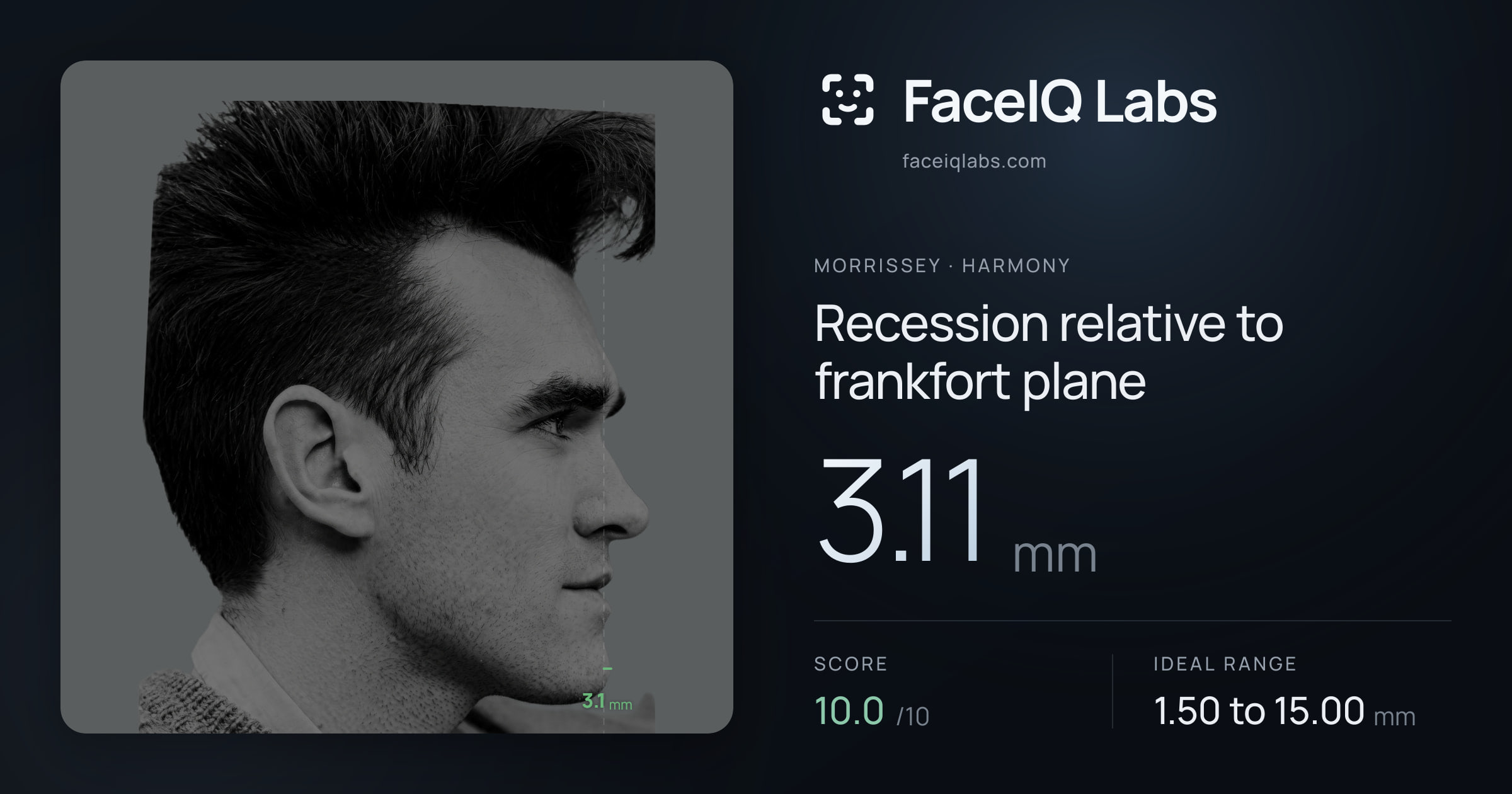 Morrissey Recession relative to frankfort plane: 3.11mm, drawn on the photo