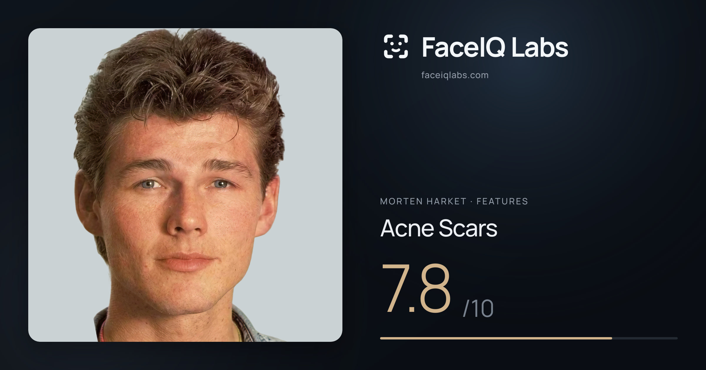 Morten Harket Acne Scars: 7.8/10, drawn on the photo