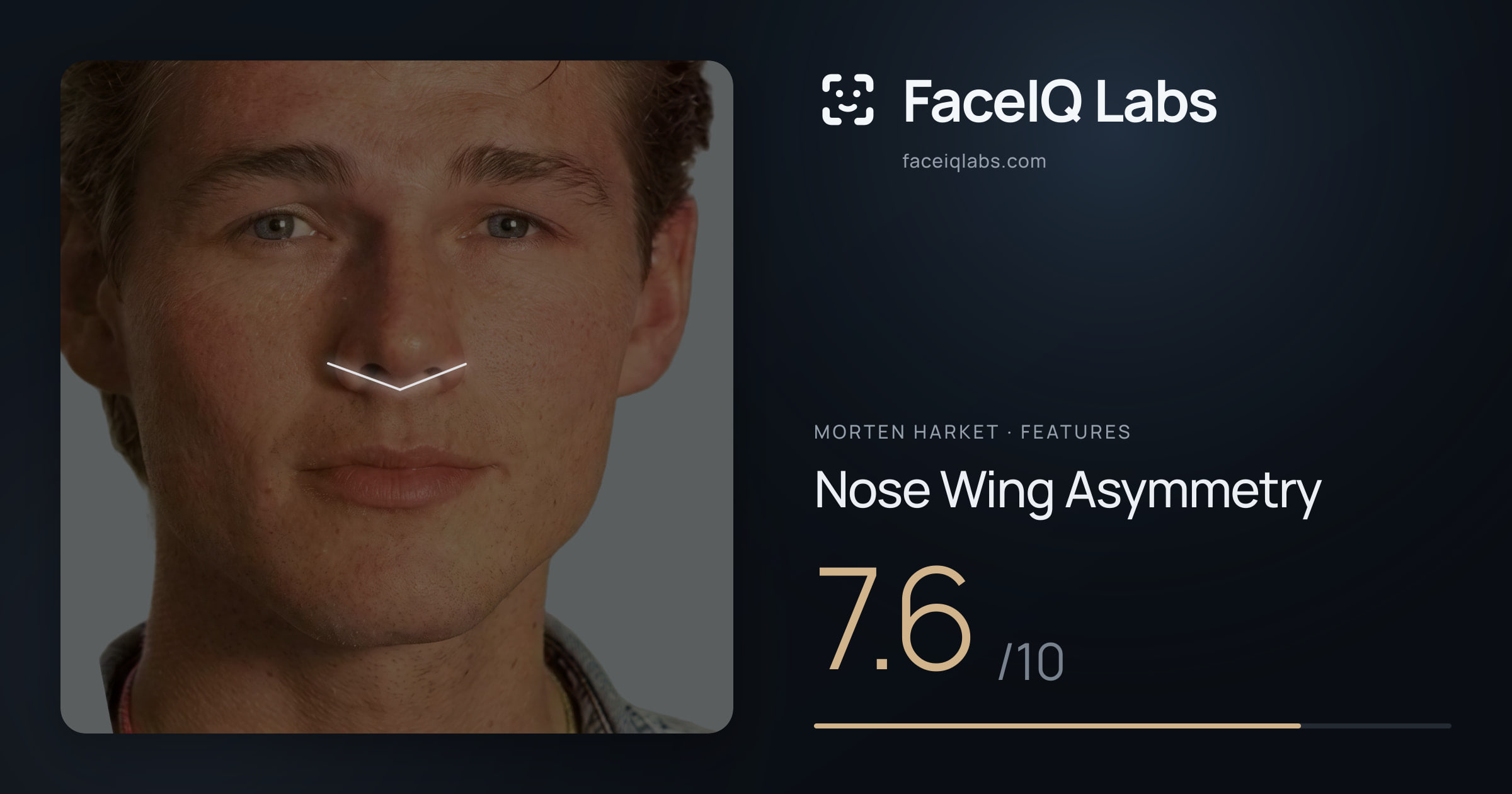 Morten Harket Nose Wing Asymmetry: 7.6/10, drawn on the photo