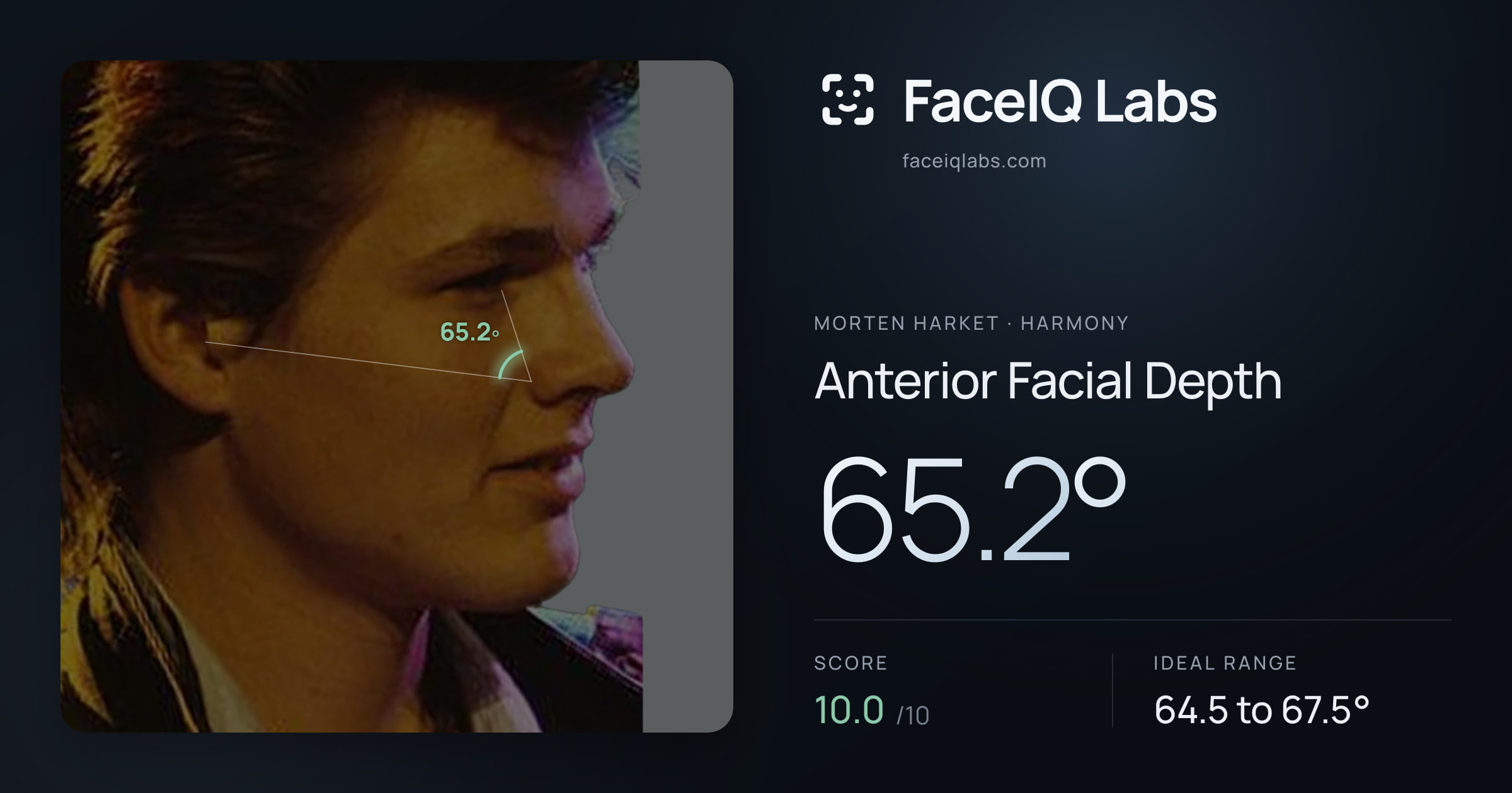 Morten Harket Anterior Facial Depth: 65.2°, drawn on the photo