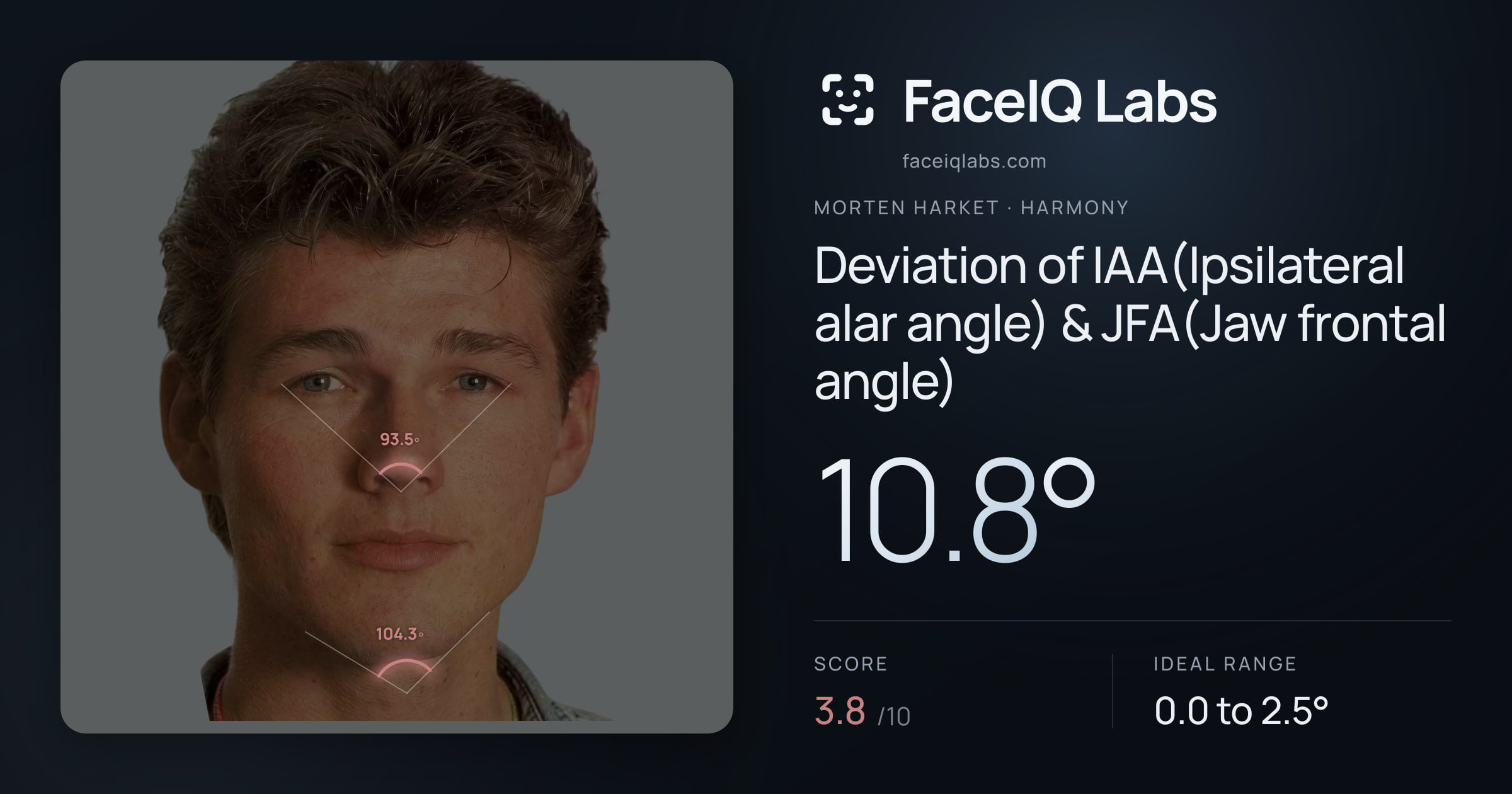 Morten Harket Deviation of IAA(Ipsilateral alar angle) & JFA(Jaw frontal angle): 10.8°, drawn on the photo