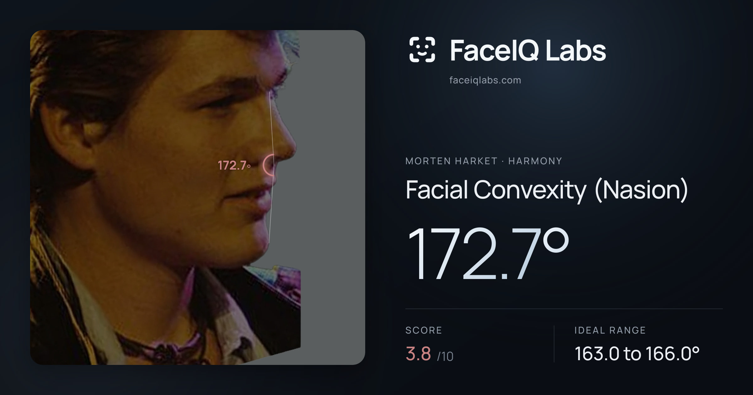 Morten Harket Facial Convexity (Nasion): 172.7°, drawn on the photo