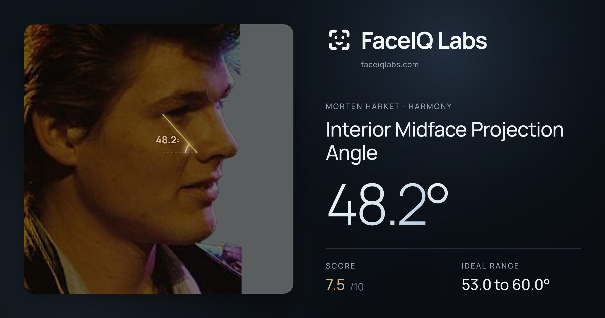 Morten Harket Interior Midface Projection Angle: 48.2°, drawn on the photo