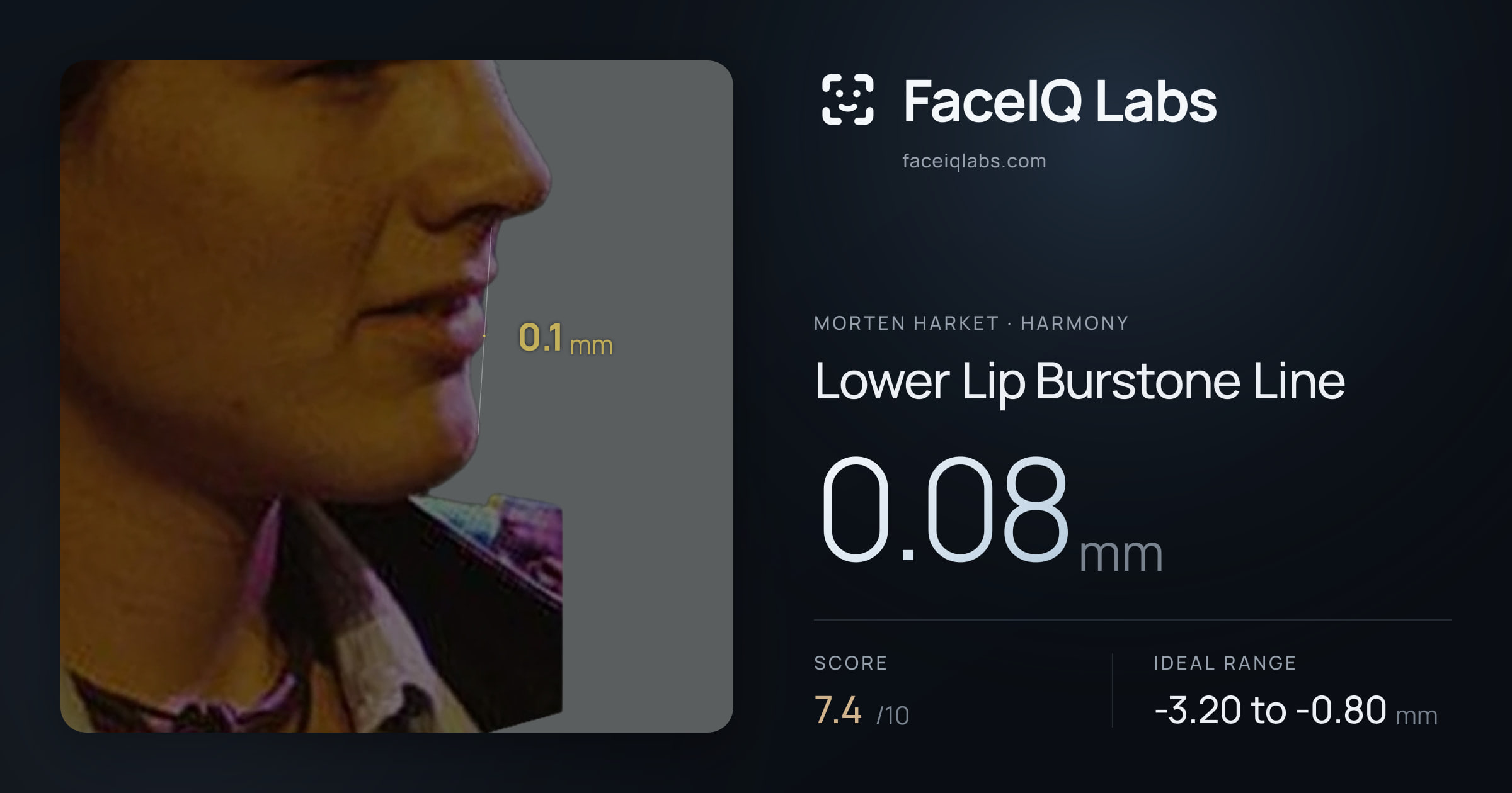 Morten Harket Lower Lip Burstone Line: 0.08mm, drawn on the photo