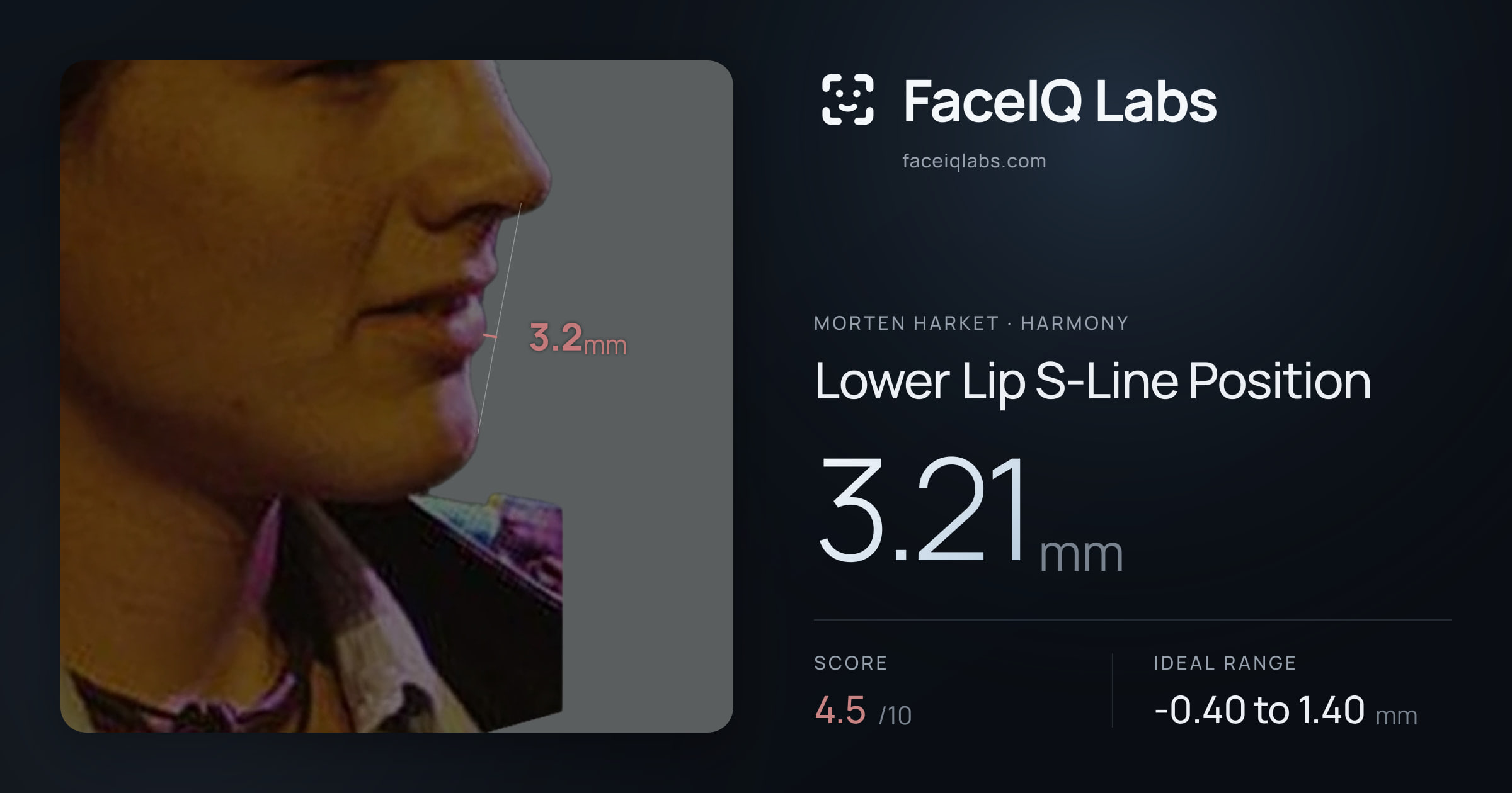 Morten Harket Lower Lip S-Line Position: 3.21mm, drawn on the photo