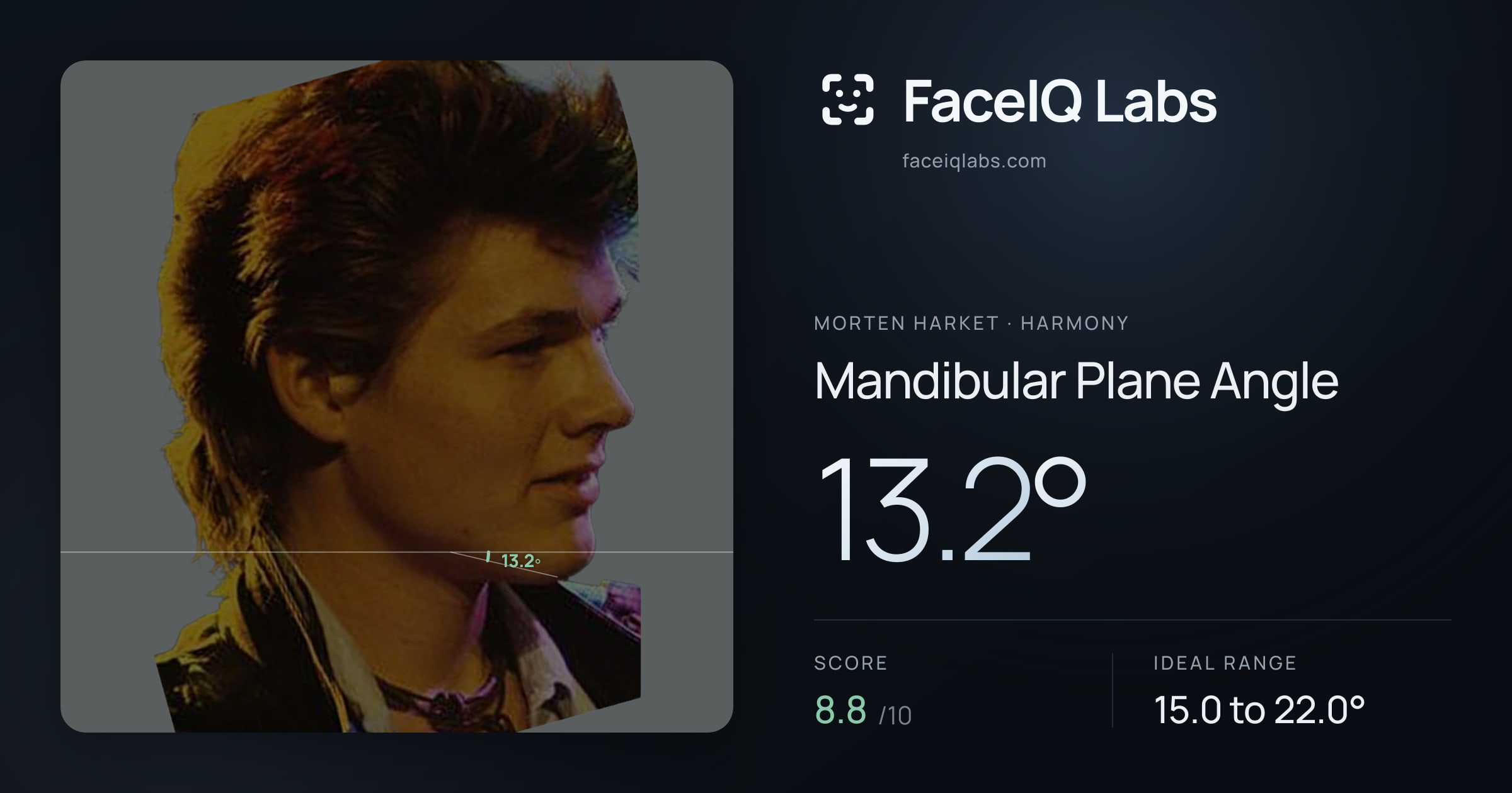Morten Harket Mandibular Plane Angle: 13.2°, drawn on the photo