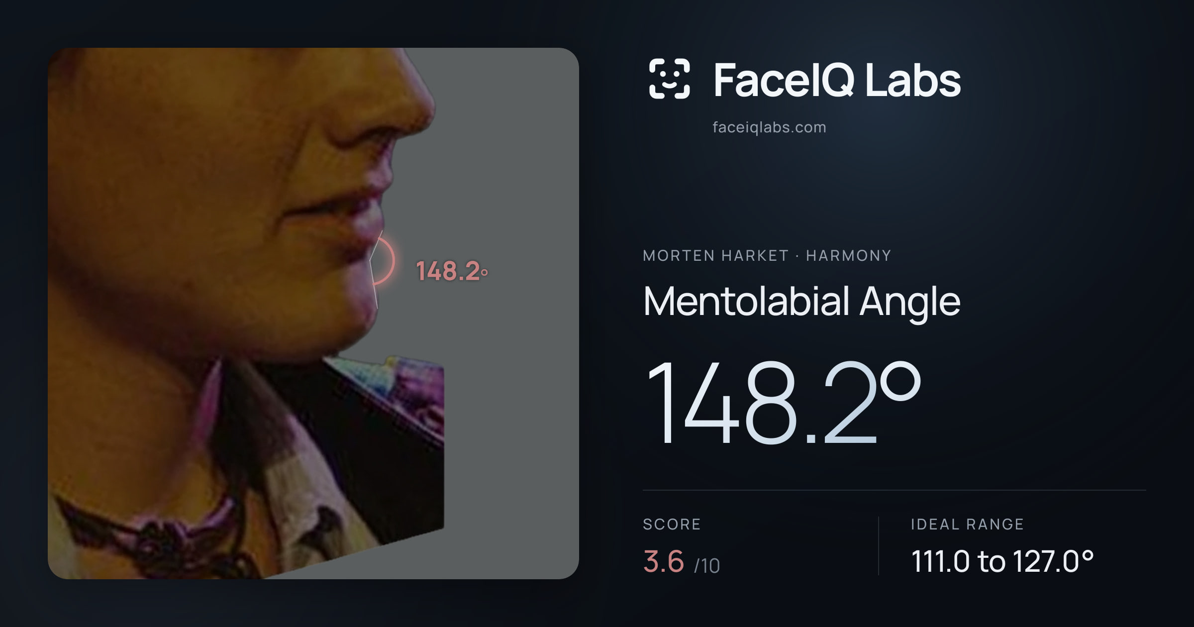 Morten Harket Mentolabial Angle: 148.2°, drawn on the photo