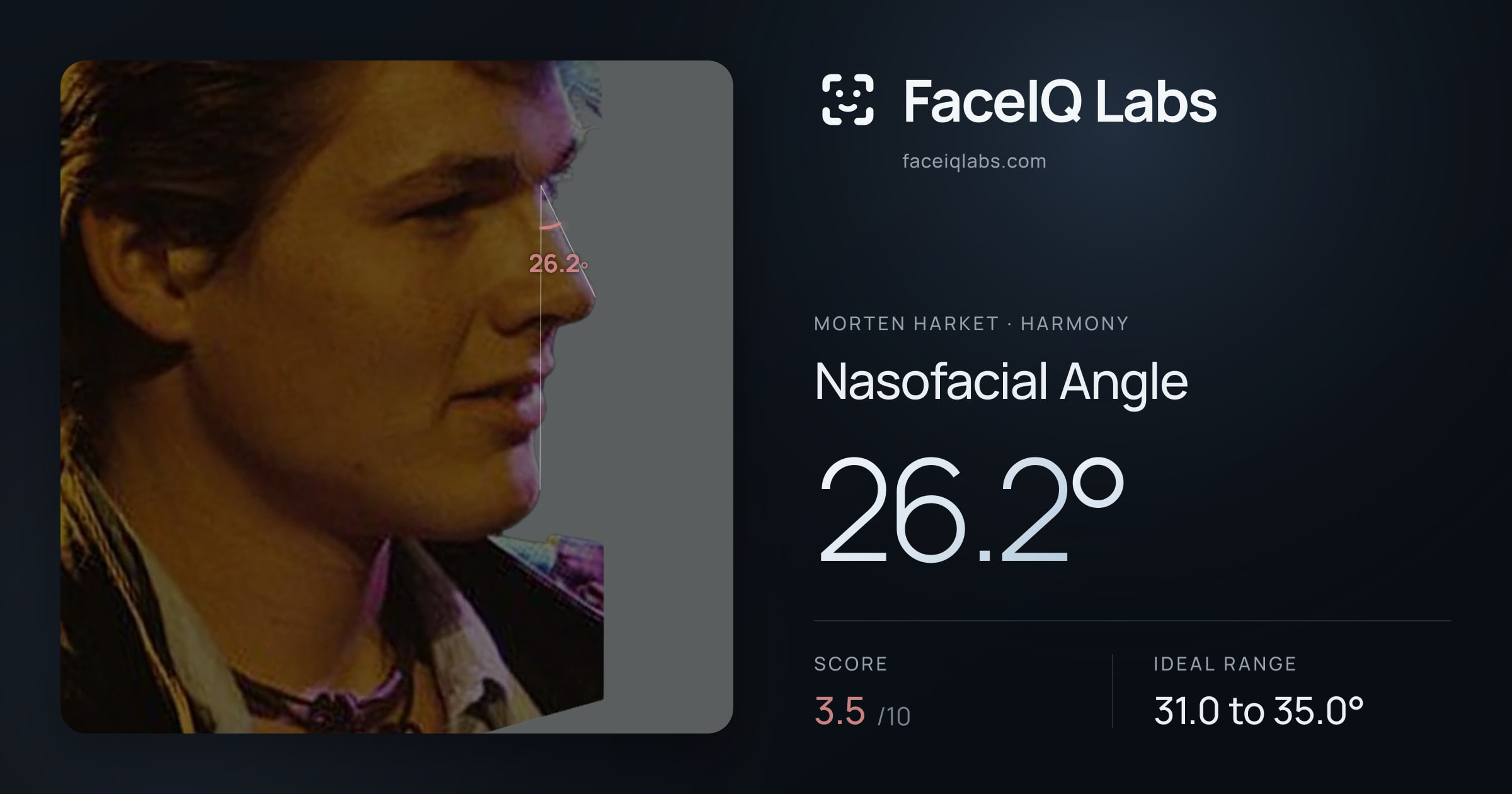 Morten Harket Nasofacial Angle: 26.2°, drawn on the photo