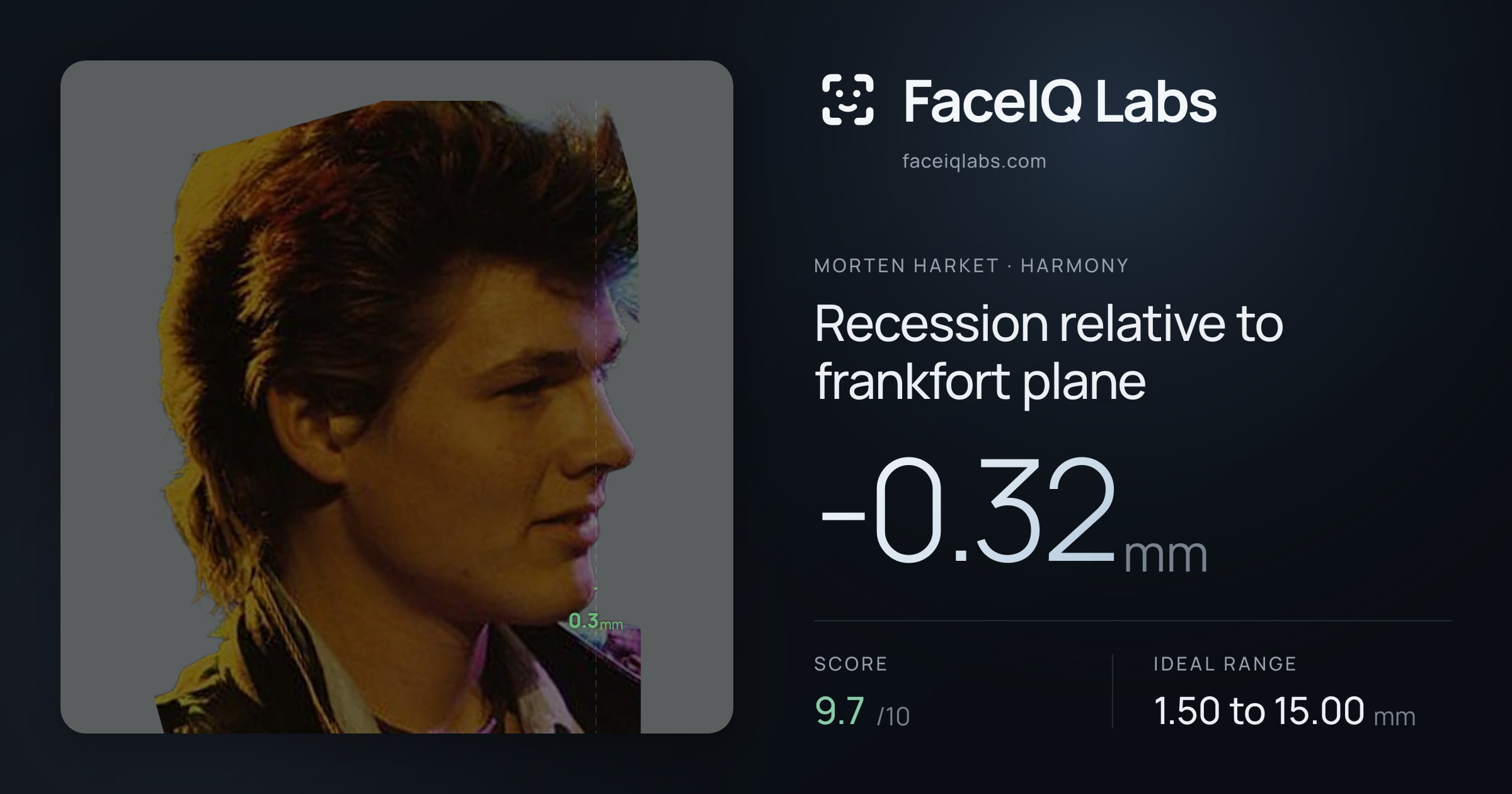 Morten Harket Recession relative to frankfort plane: -0.32mm, drawn on the photo