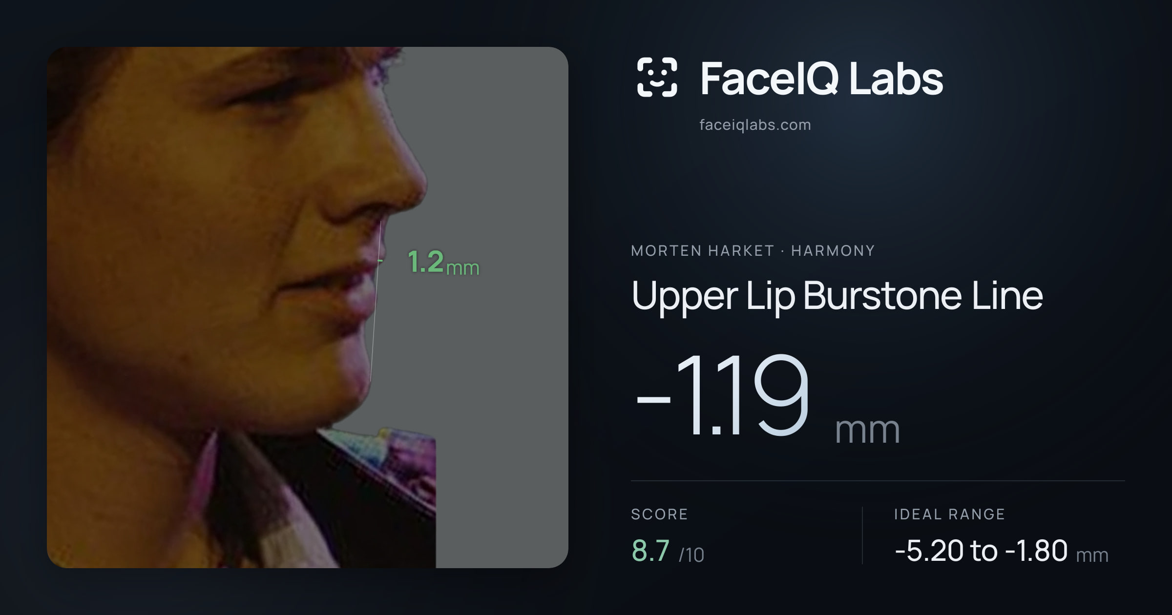Morten Harket Upper Lip Burstone Line: -1.19mm, drawn on the photo