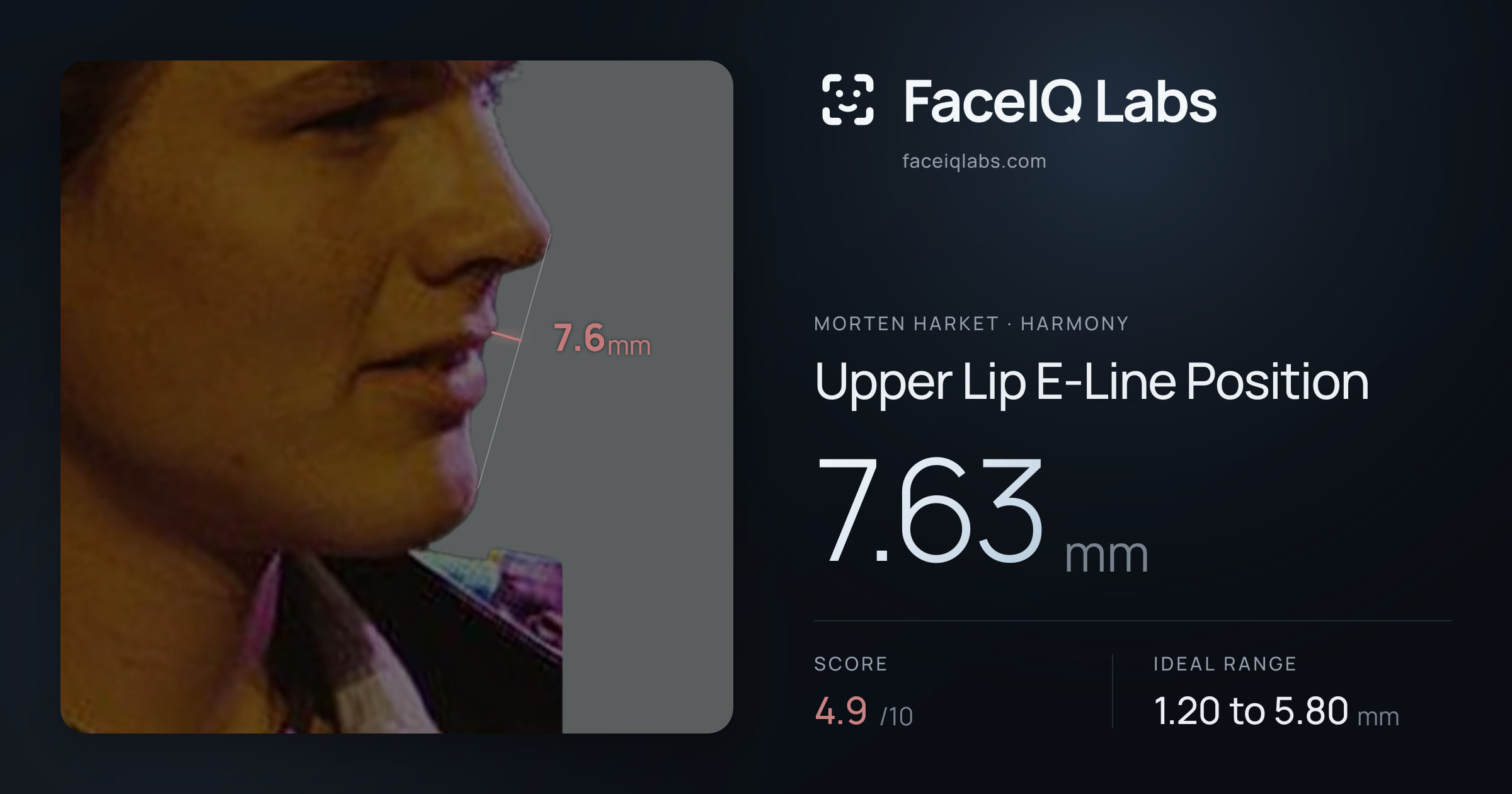 Morten Harket Upper Lip E-Line Position: 7.63mm, drawn on the photo