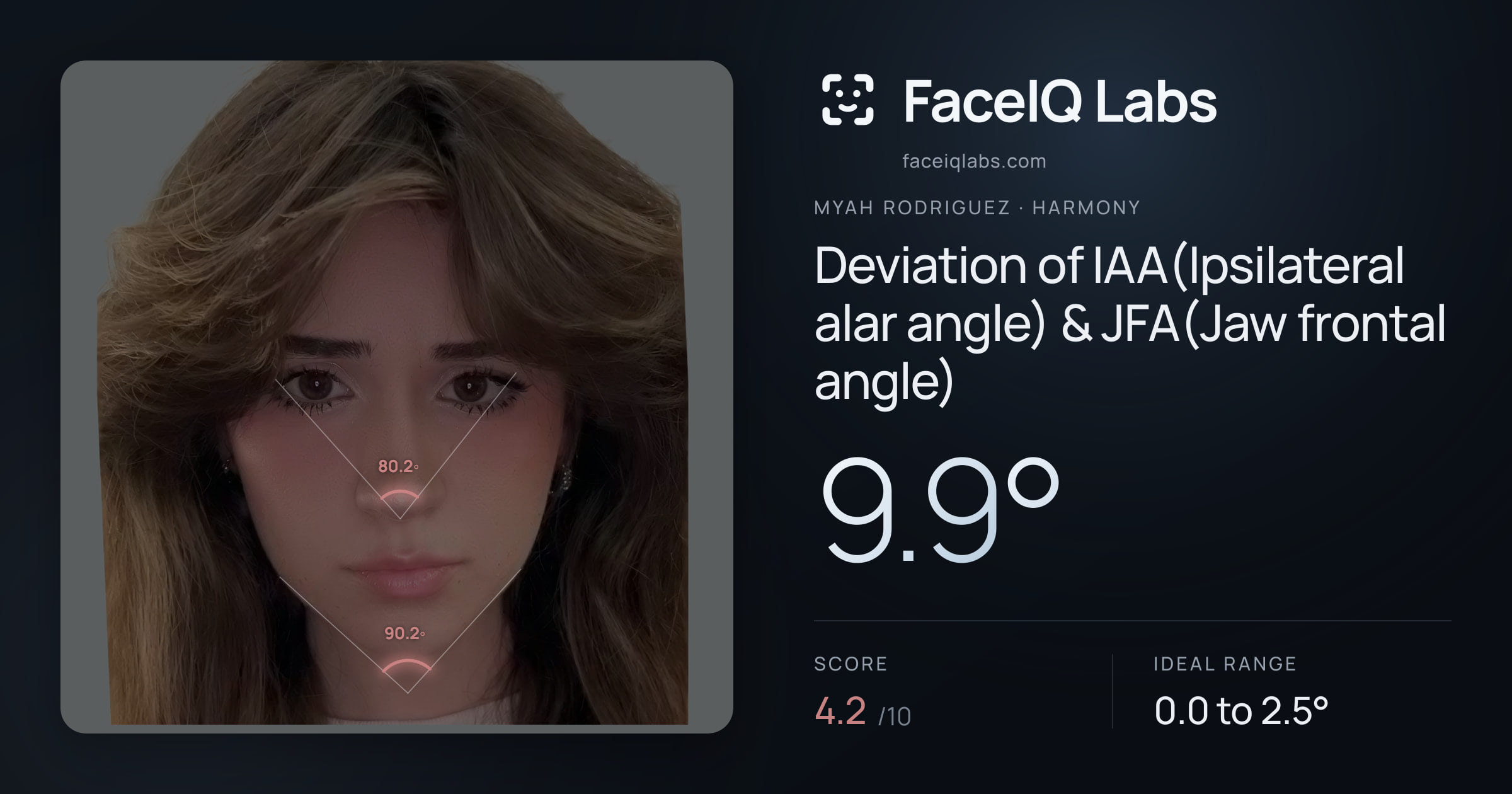 Myah Rodriguez Deviation of IAA(Ipsilateral alar angle) & JFA(Jaw frontal angle): 9.9°, drawn on the photo