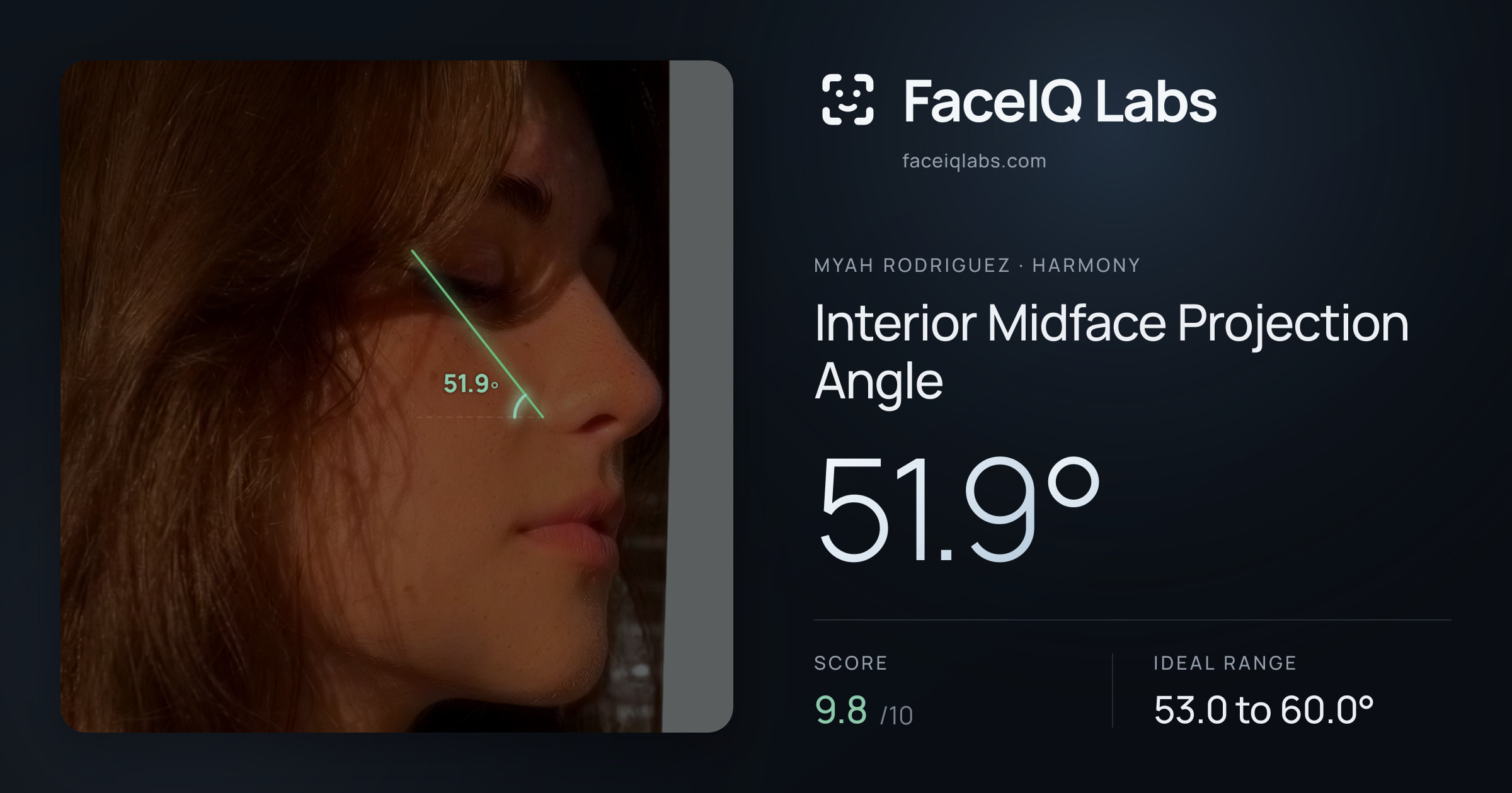 Myah Rodriguez Interior Midface Projection Angle: 51.9°, drawn on the photo