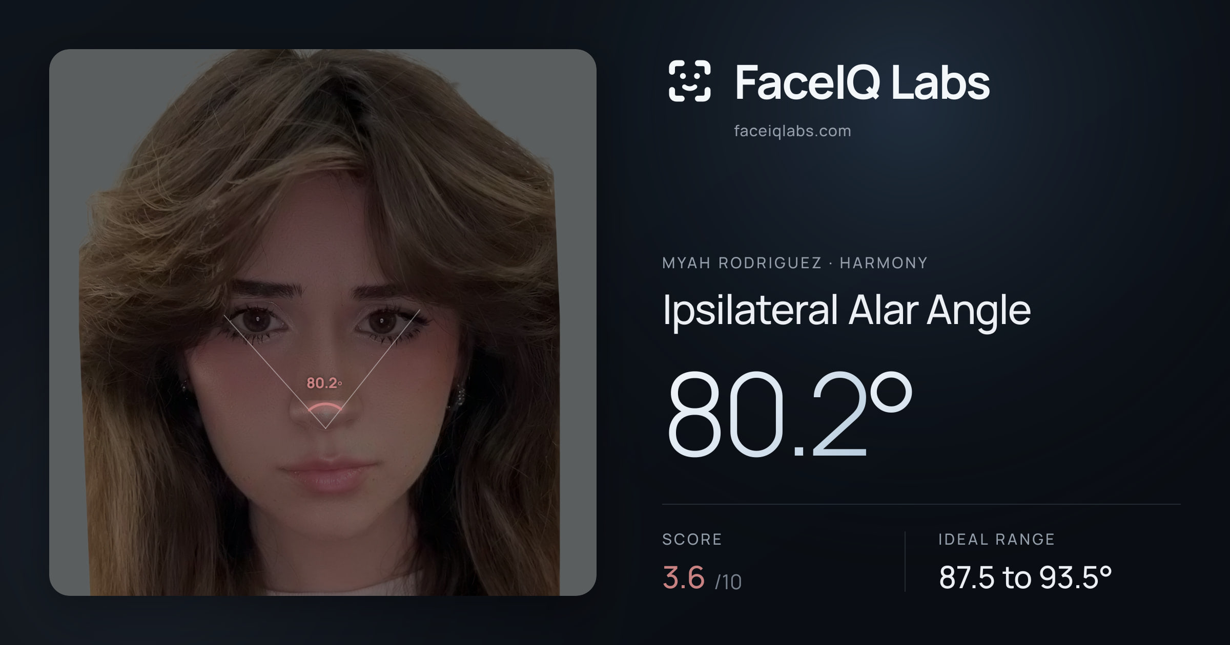 Myah Rodriguez Ipsilateral Alar Angle: 80.2°, drawn on the photo