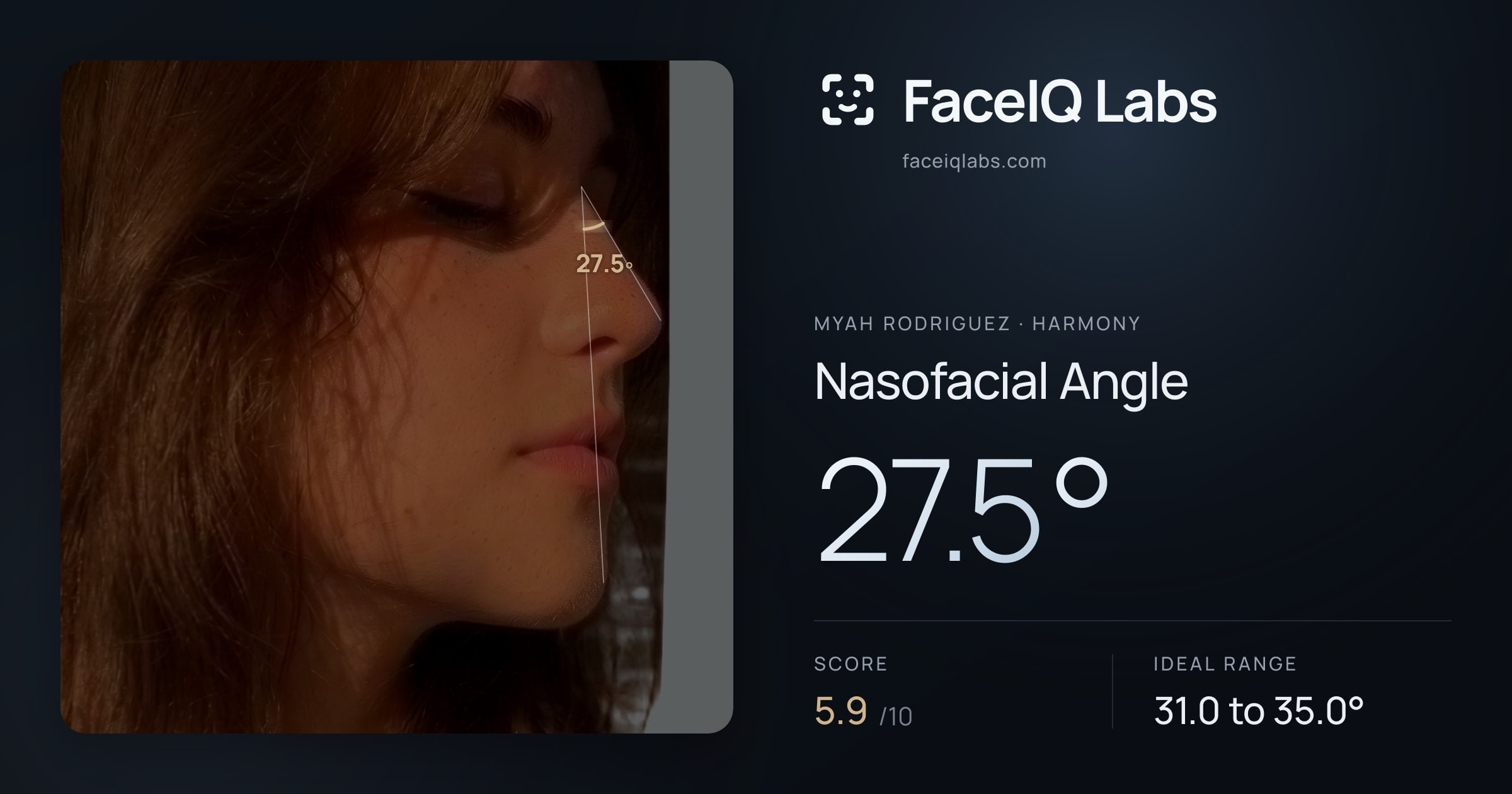 Myah Rodriguez Nasofacial Angle: 27.5°, drawn on the photo