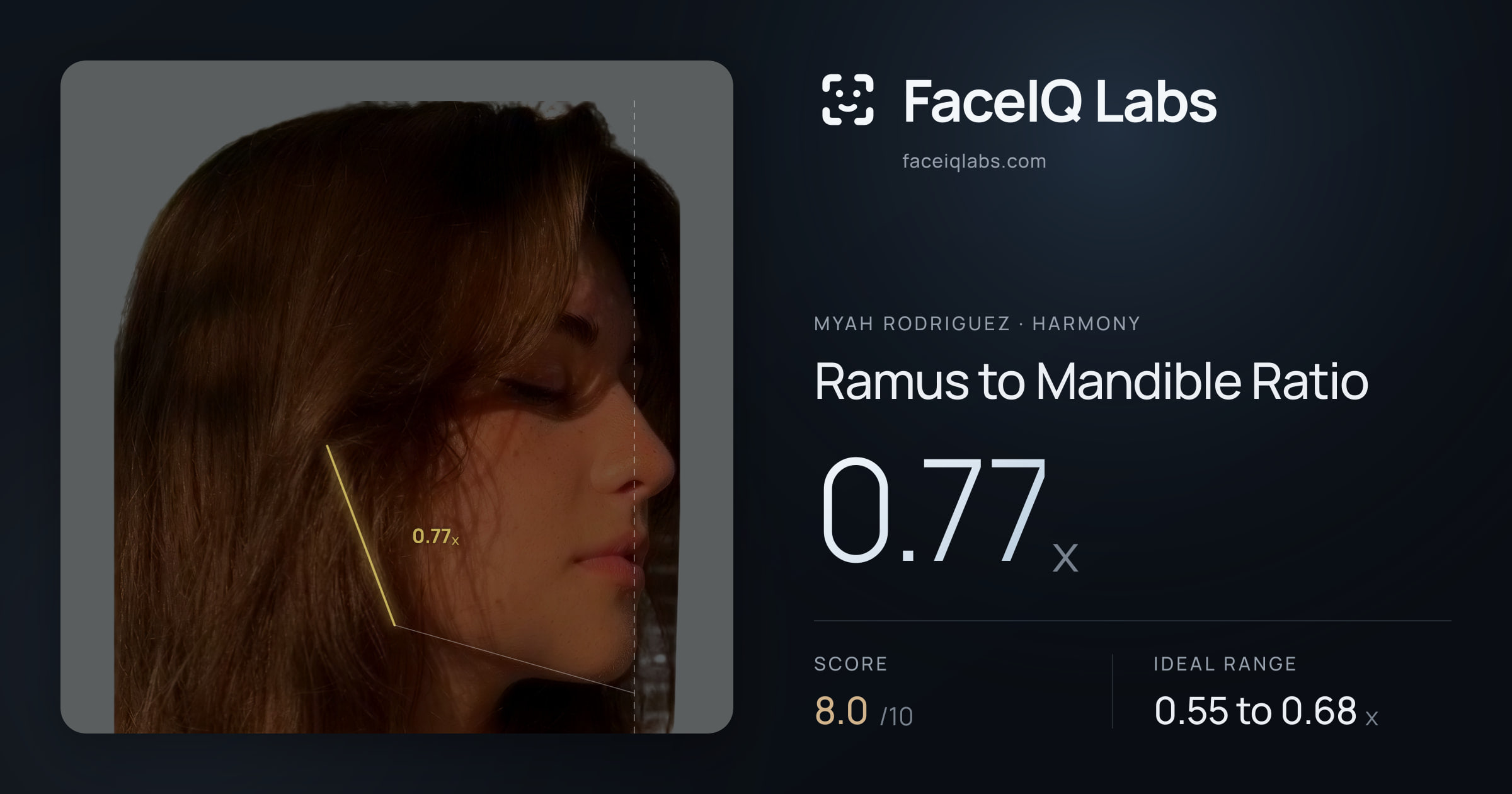 Myah Rodriguez Ramus to Mandible Ratio: 0.77x, drawn on the photo