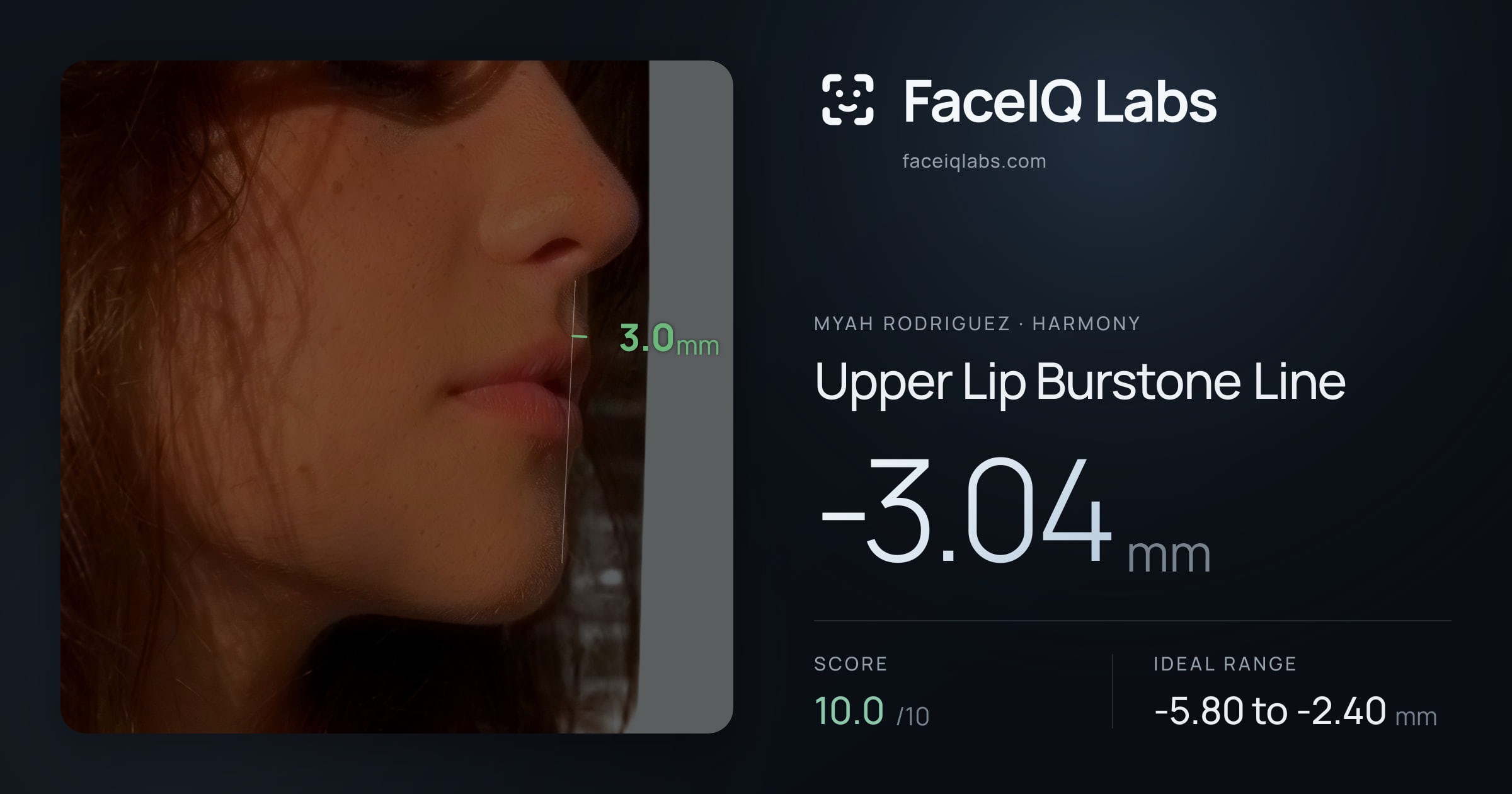 Myah Rodriguez Upper Lip Burstone Line: -3.04mm, drawn on the photo