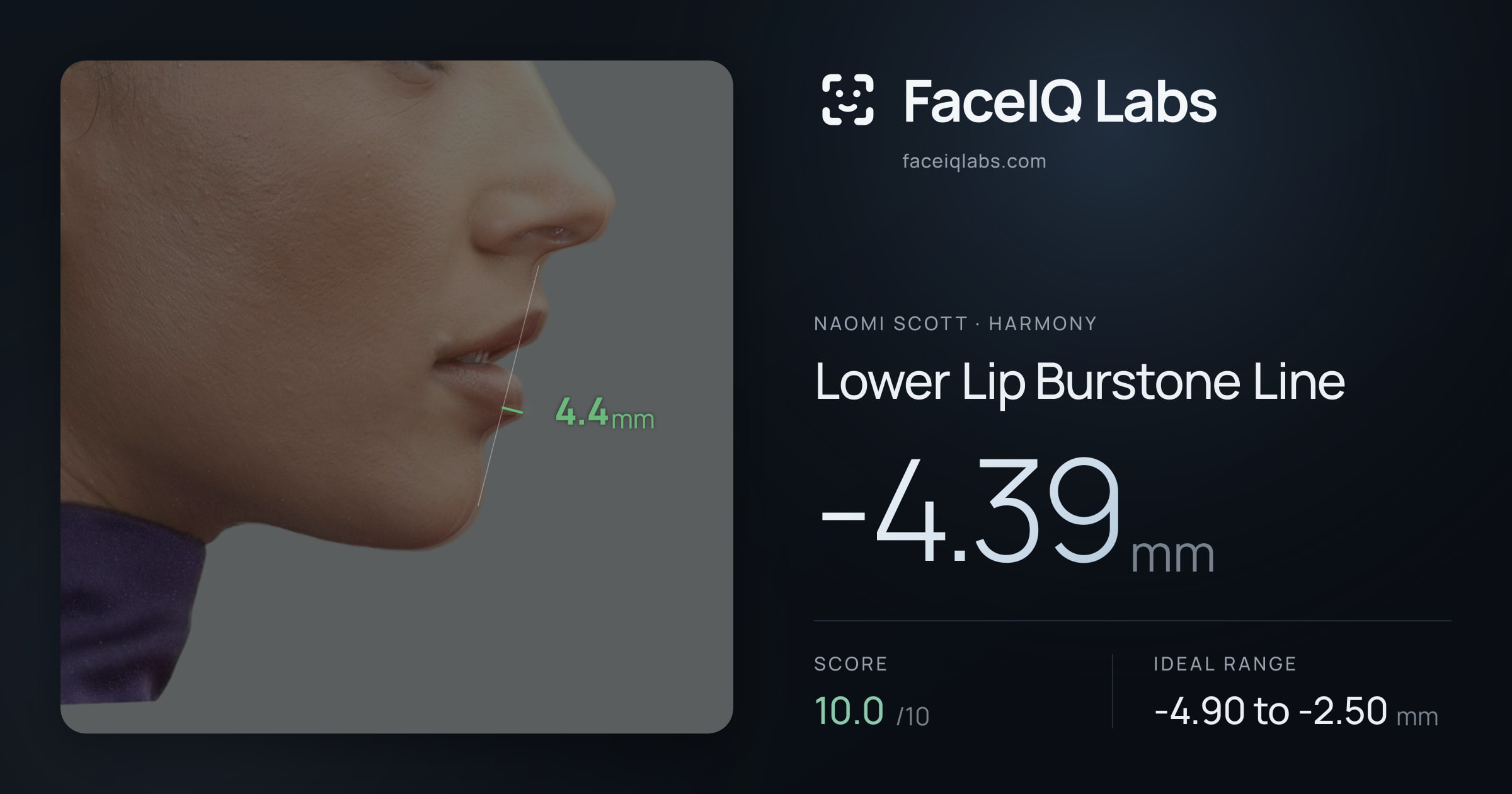 Naomi Scott Lower Lip Burstone Line: -4.39mm, drawn on the photo