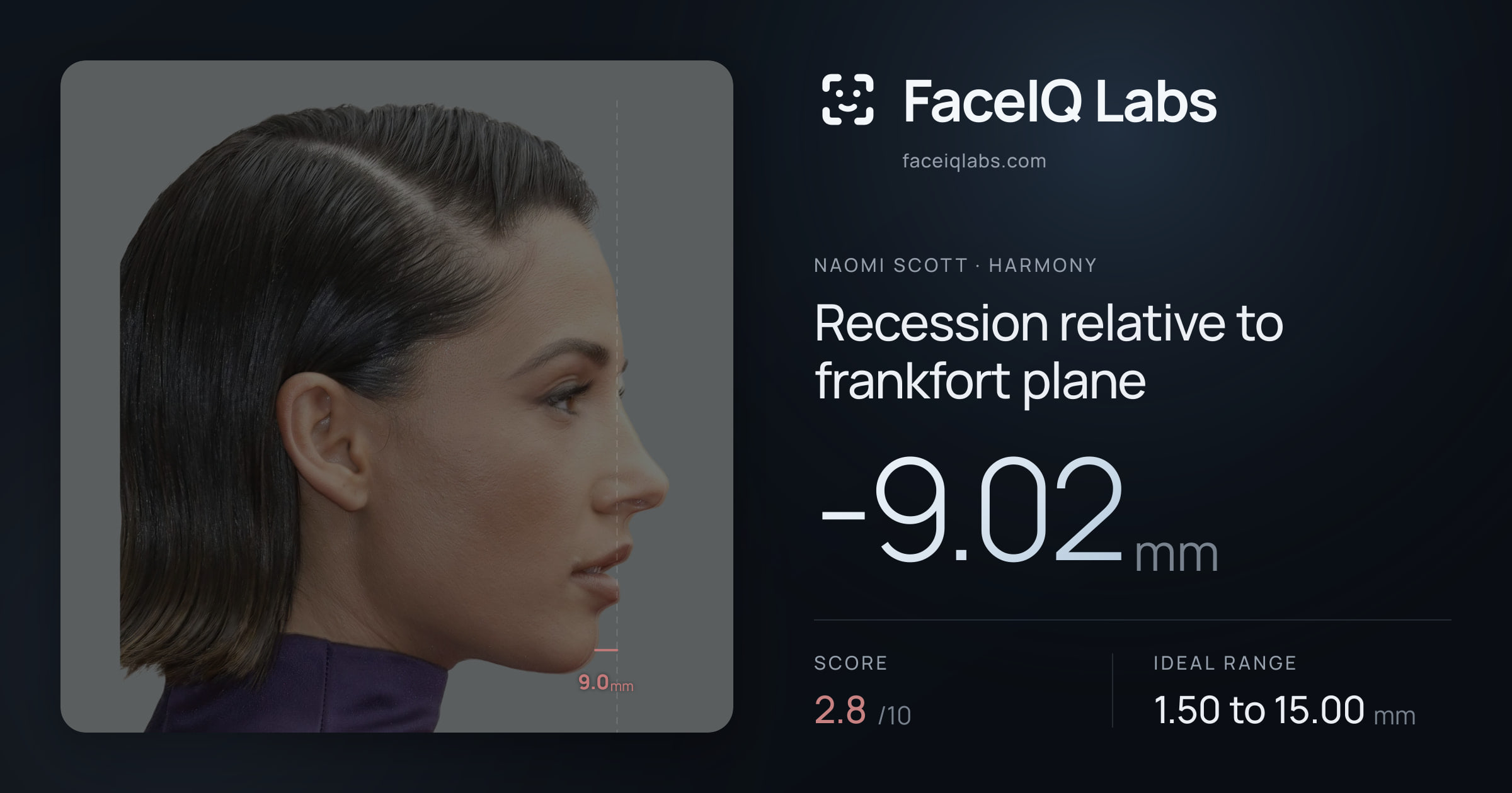 Naomi Scott Recession relative to frankfort plane: -9.02mm, drawn on the photo