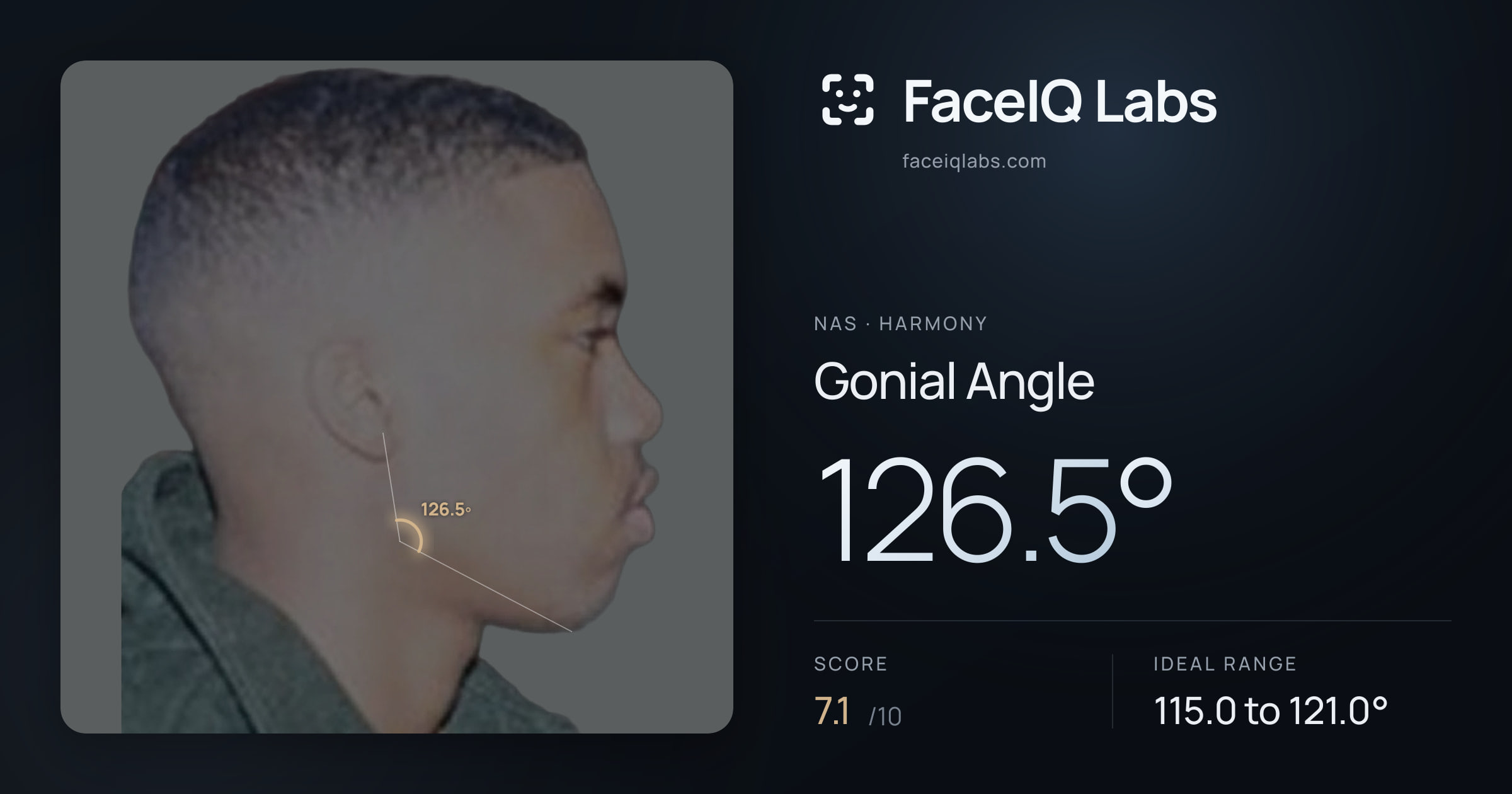 Nas Gonial Angle: 126.5°, drawn on the photo