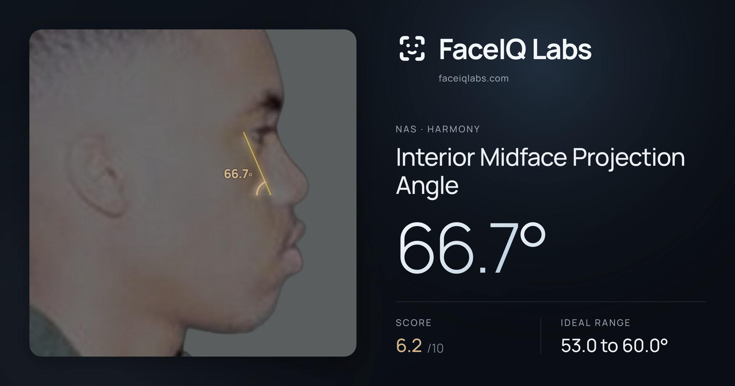 Nas Interior Midface Projection Angle: 66.7°, drawn on the photo