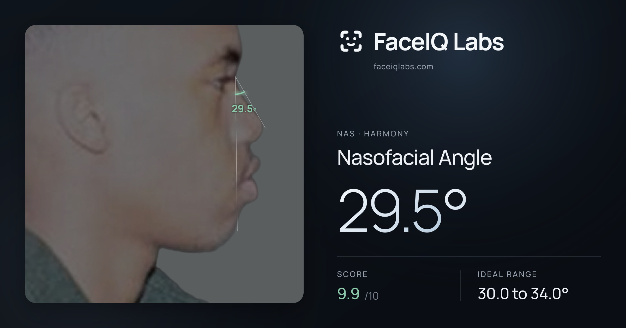 Nas Nasofacial Angle: 29.5°, drawn on the photo