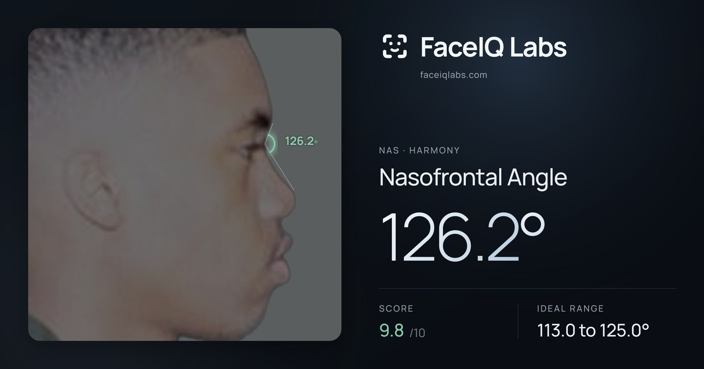 Nas Nasofrontal Angle: 126.2°, drawn on the photo