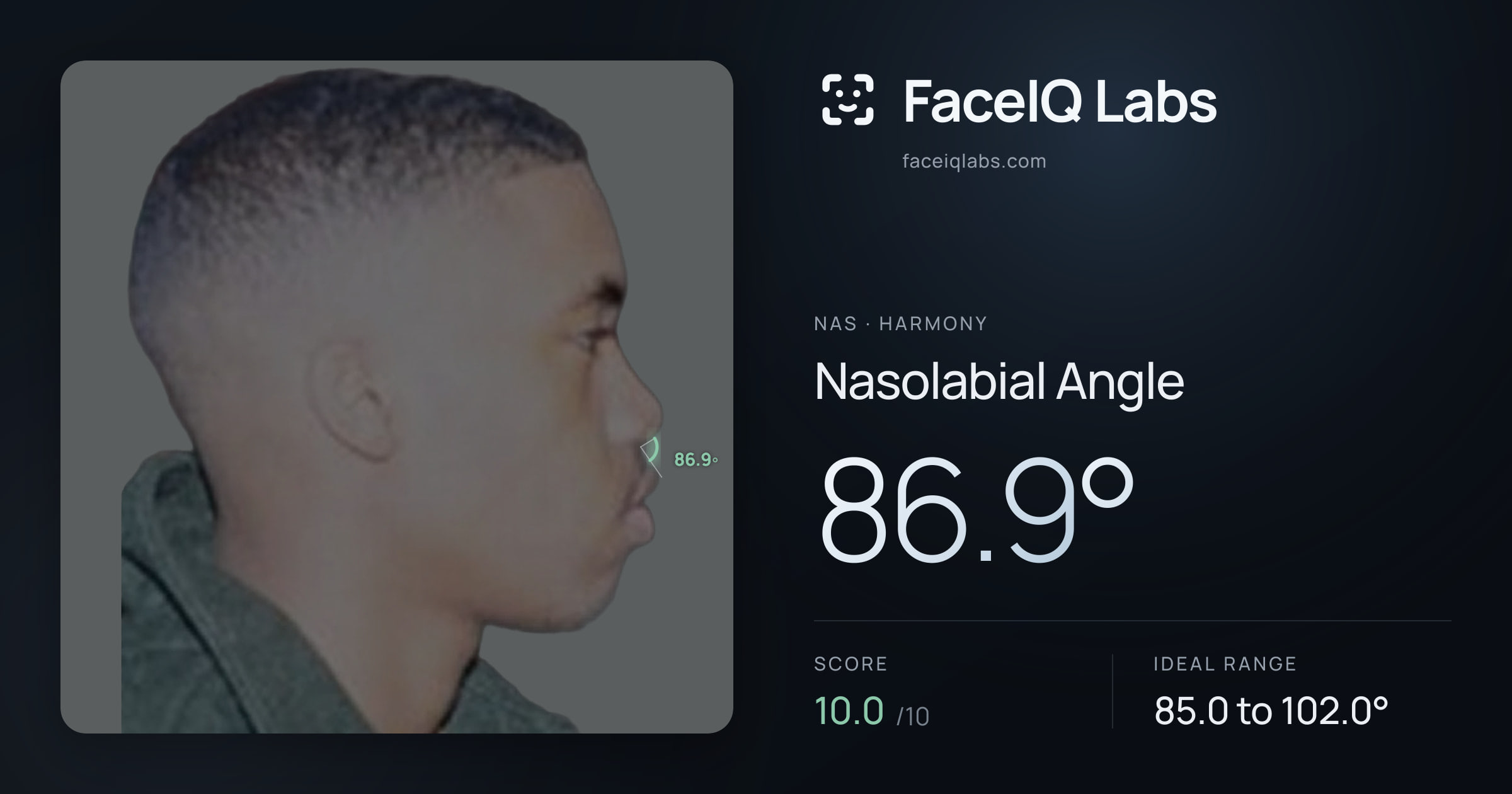 Nas Nasolabial Angle: 86.9°, drawn on the photo