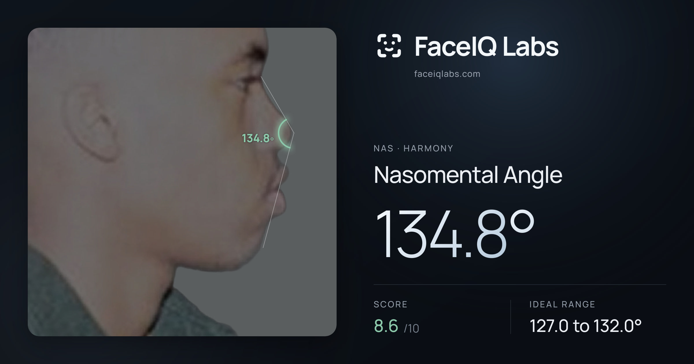 Nas Nasomental Angle: 134.8°, drawn on the photo