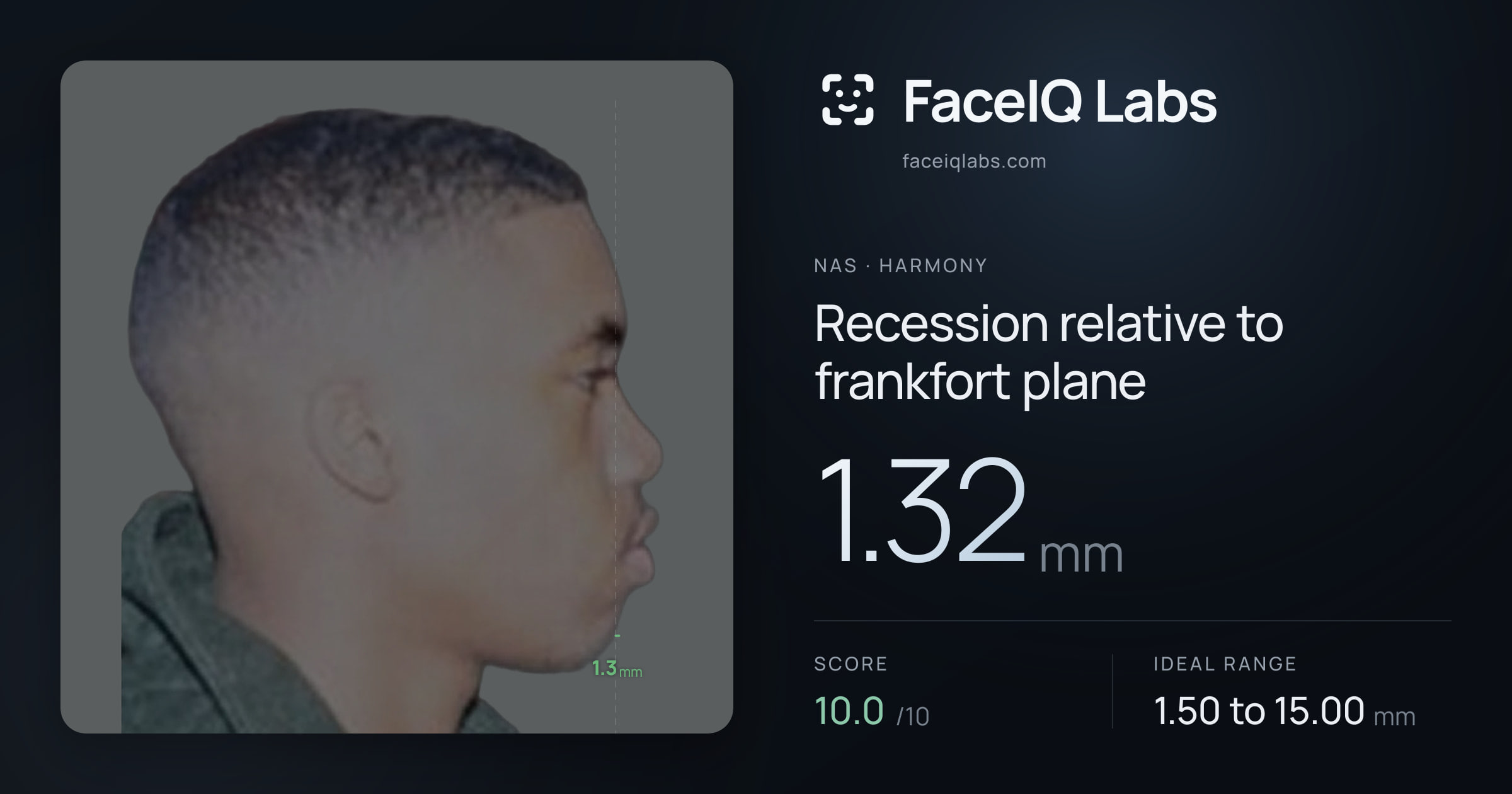 Nas Recession relative to frankfort plane: 1.32mm, drawn on the photo