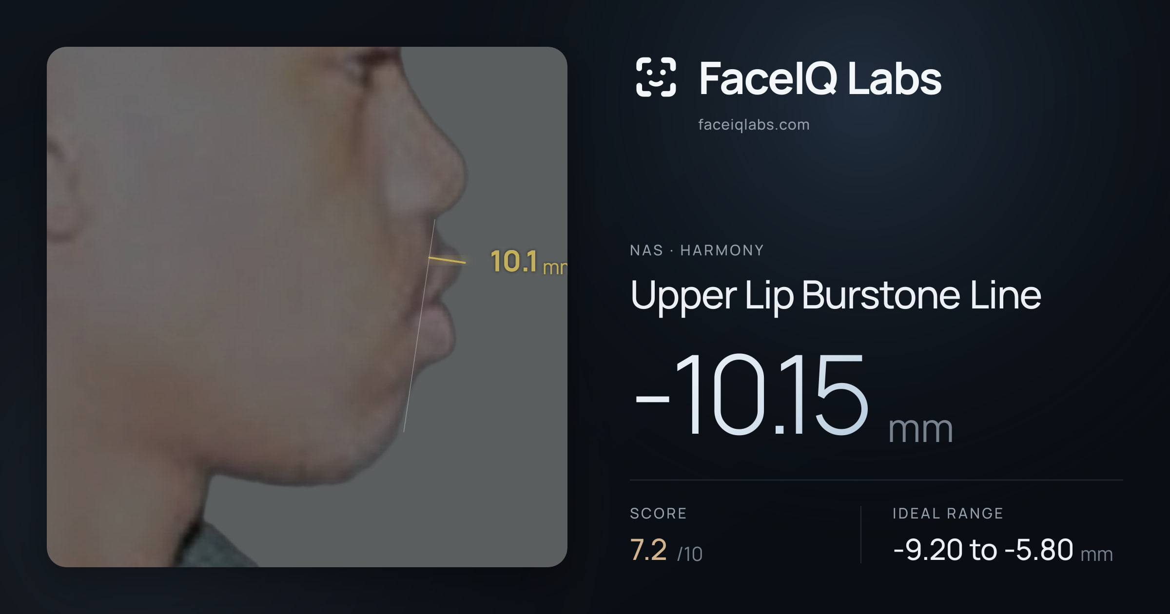 Nas Upper Lip Burstone Line: -10.15mm, drawn on the photo