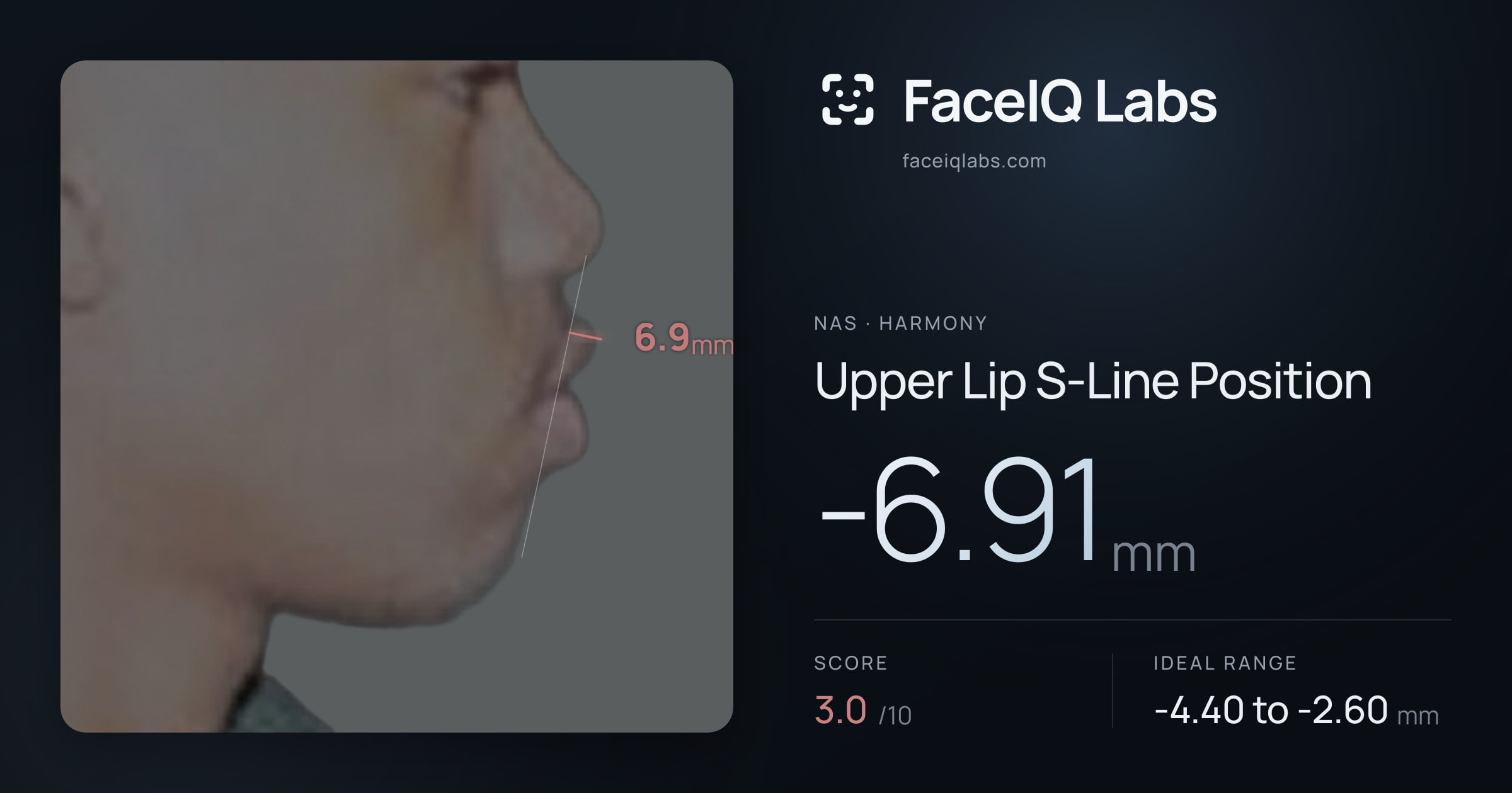 Nas Upper Lip S-Line Position: -6.91mm, drawn on the photo