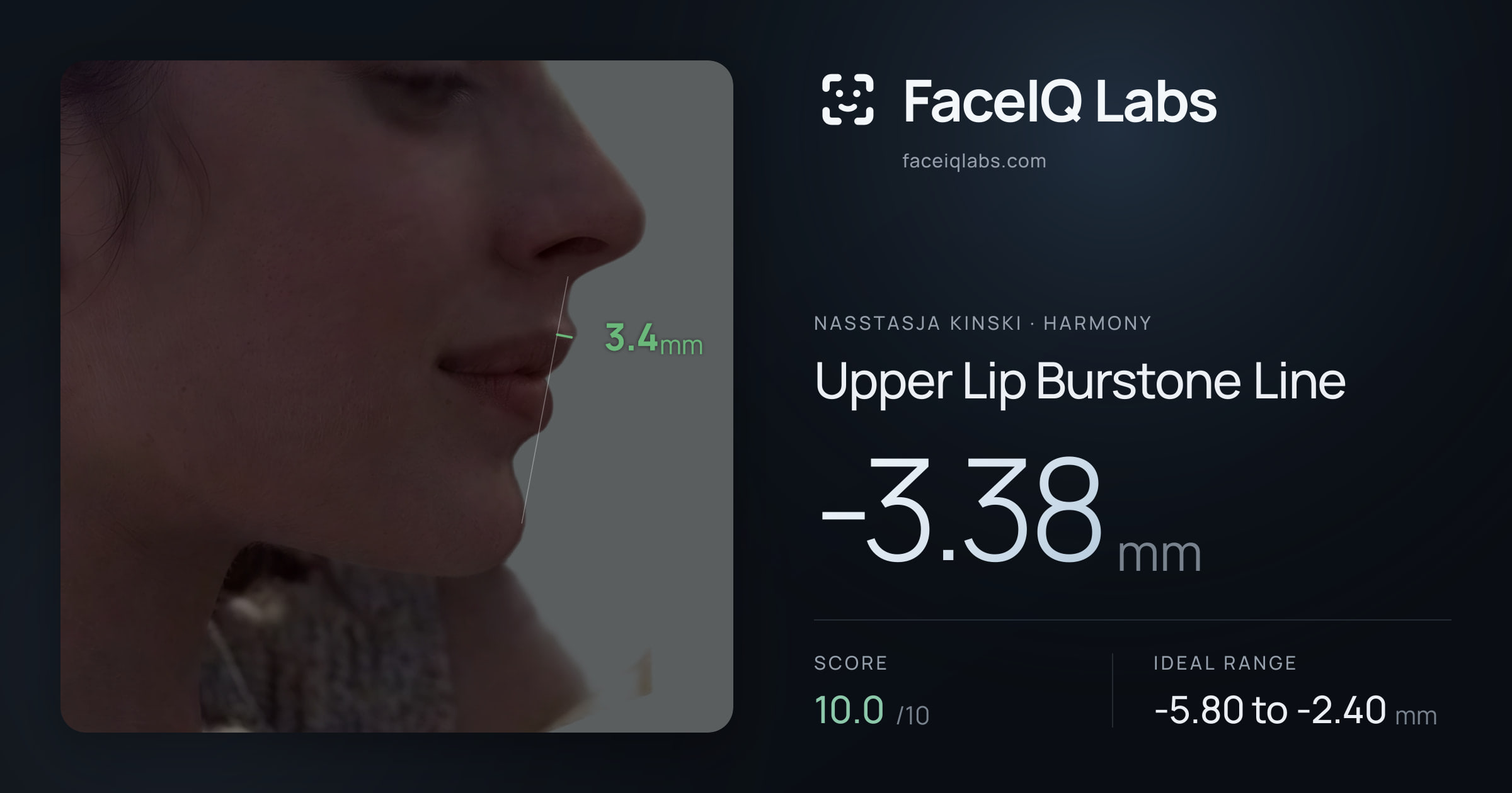 Nasstasja Kinski Upper Lip Burstone Line: -3.38mm, drawn on the photo