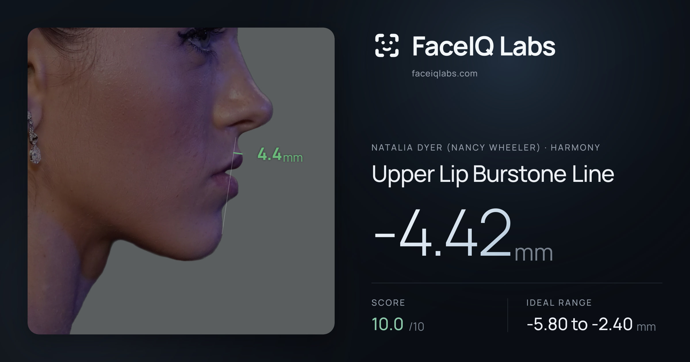 Natalia Dyer (Nancy Wheeler) Upper Lip Burstone Line: -4.42mm, drawn on the photo